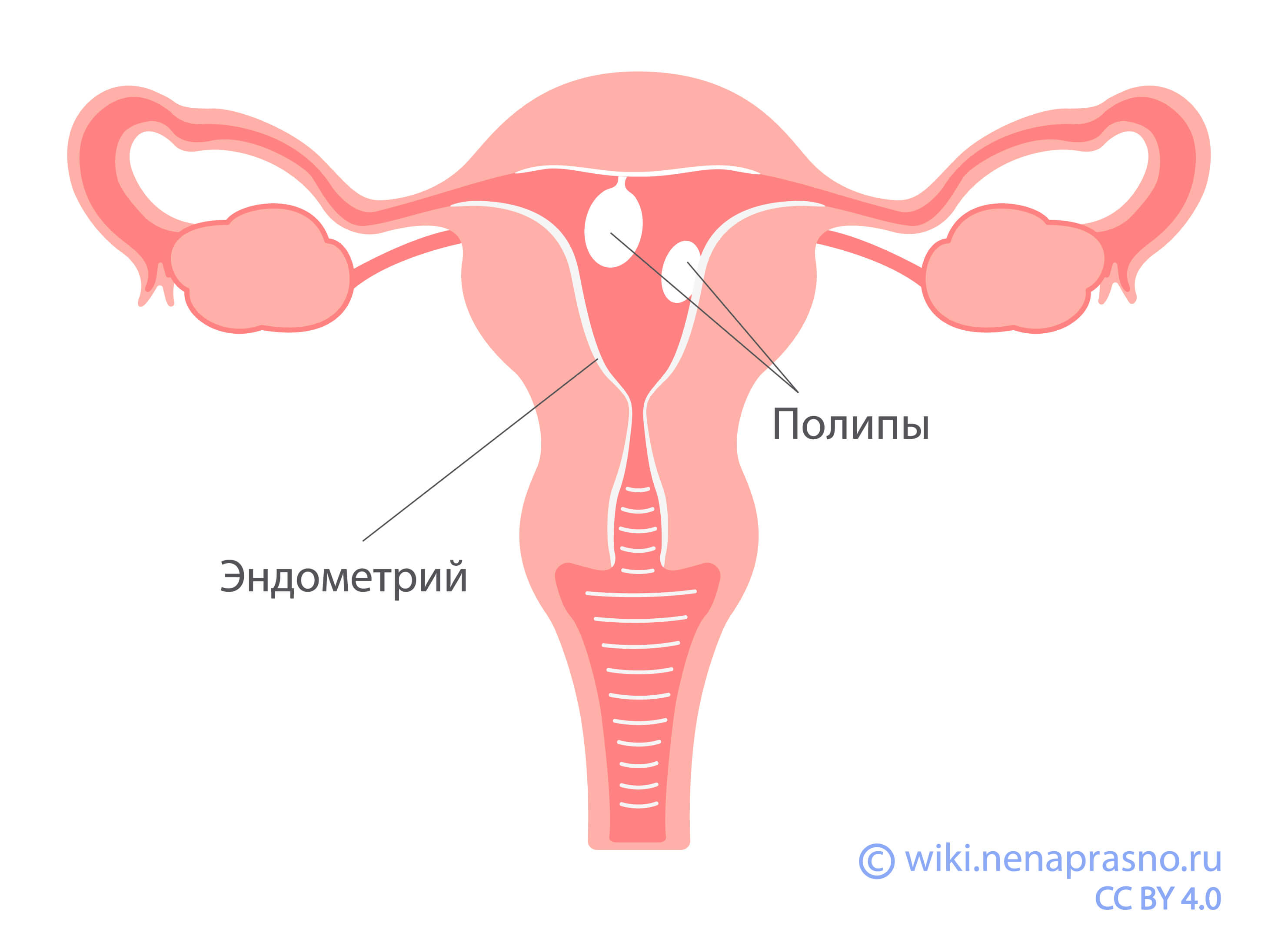 Незлокачественные заболевания матки