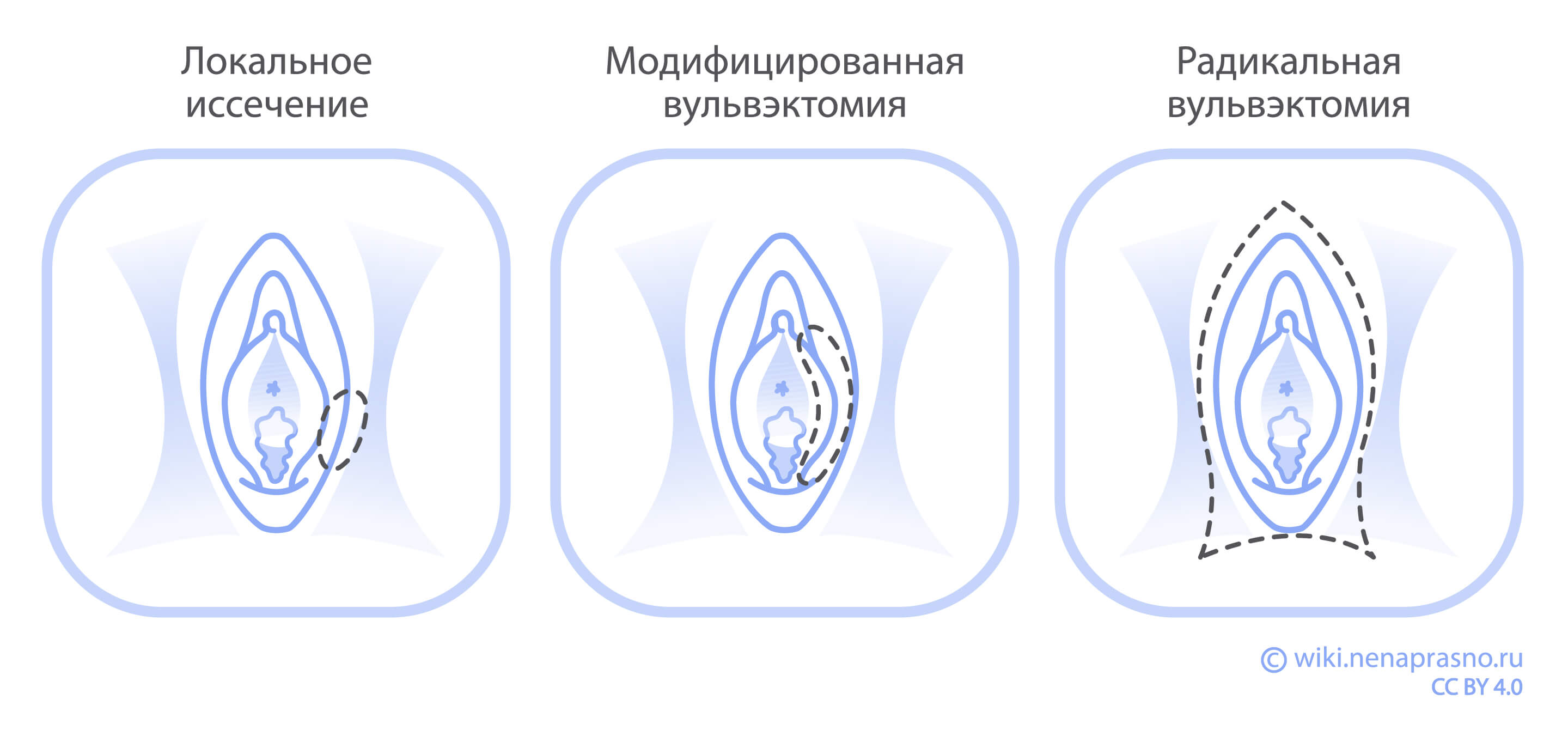 Лечение опухолей вульвы