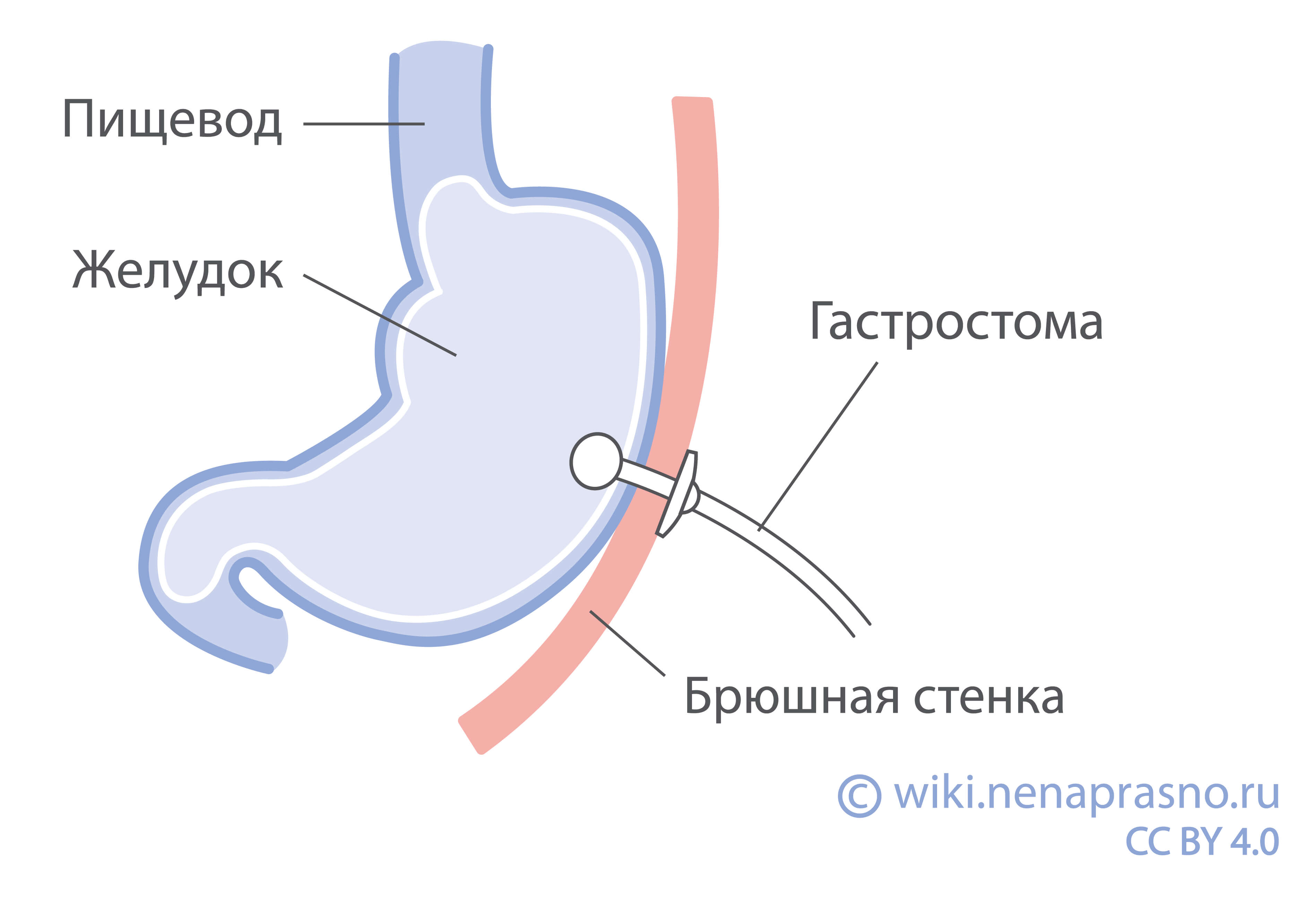 Хирургия в паллиативных целях при раке желудка