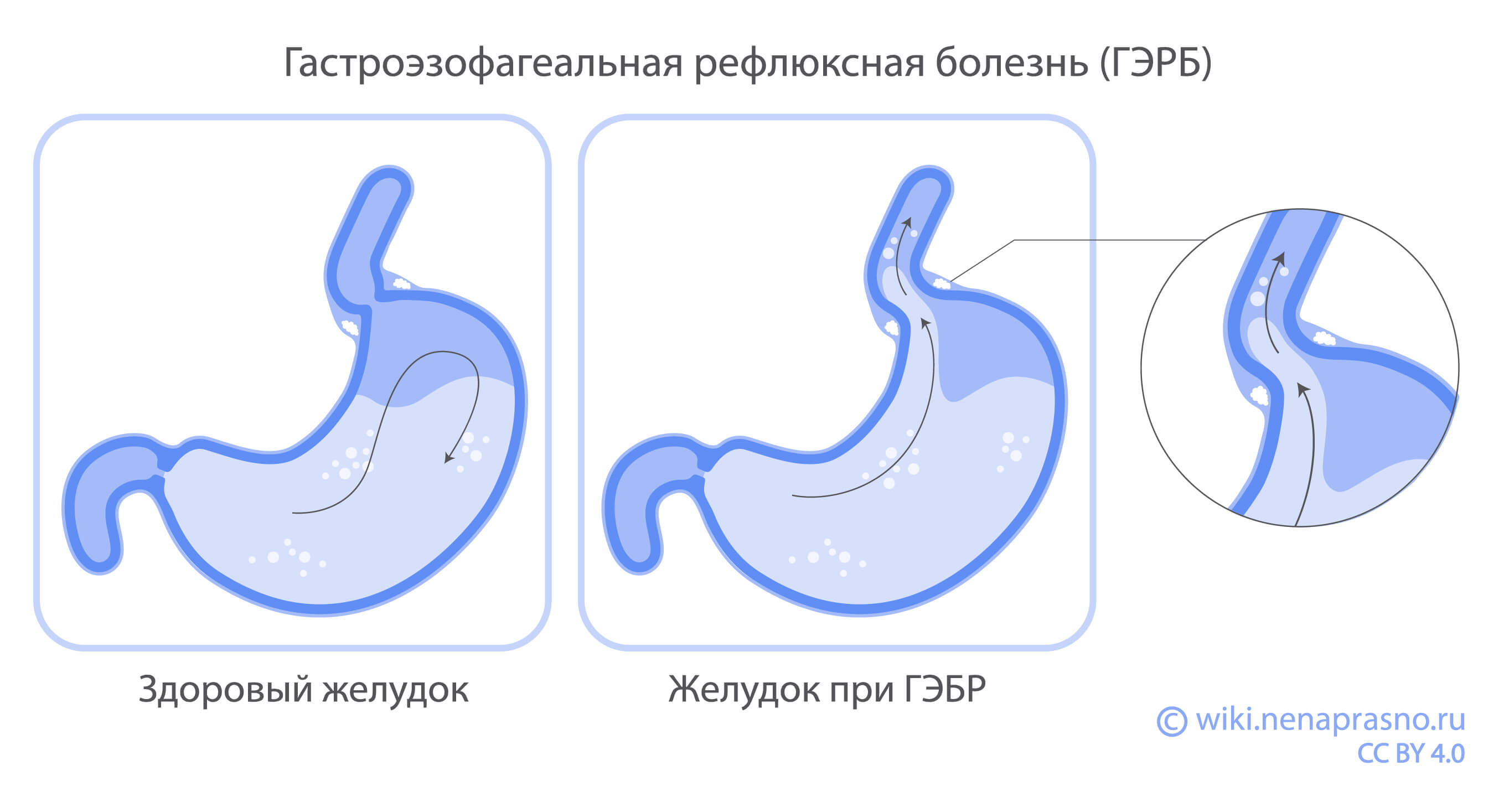 Гастроэзофагеальная рефлюксная болезнь