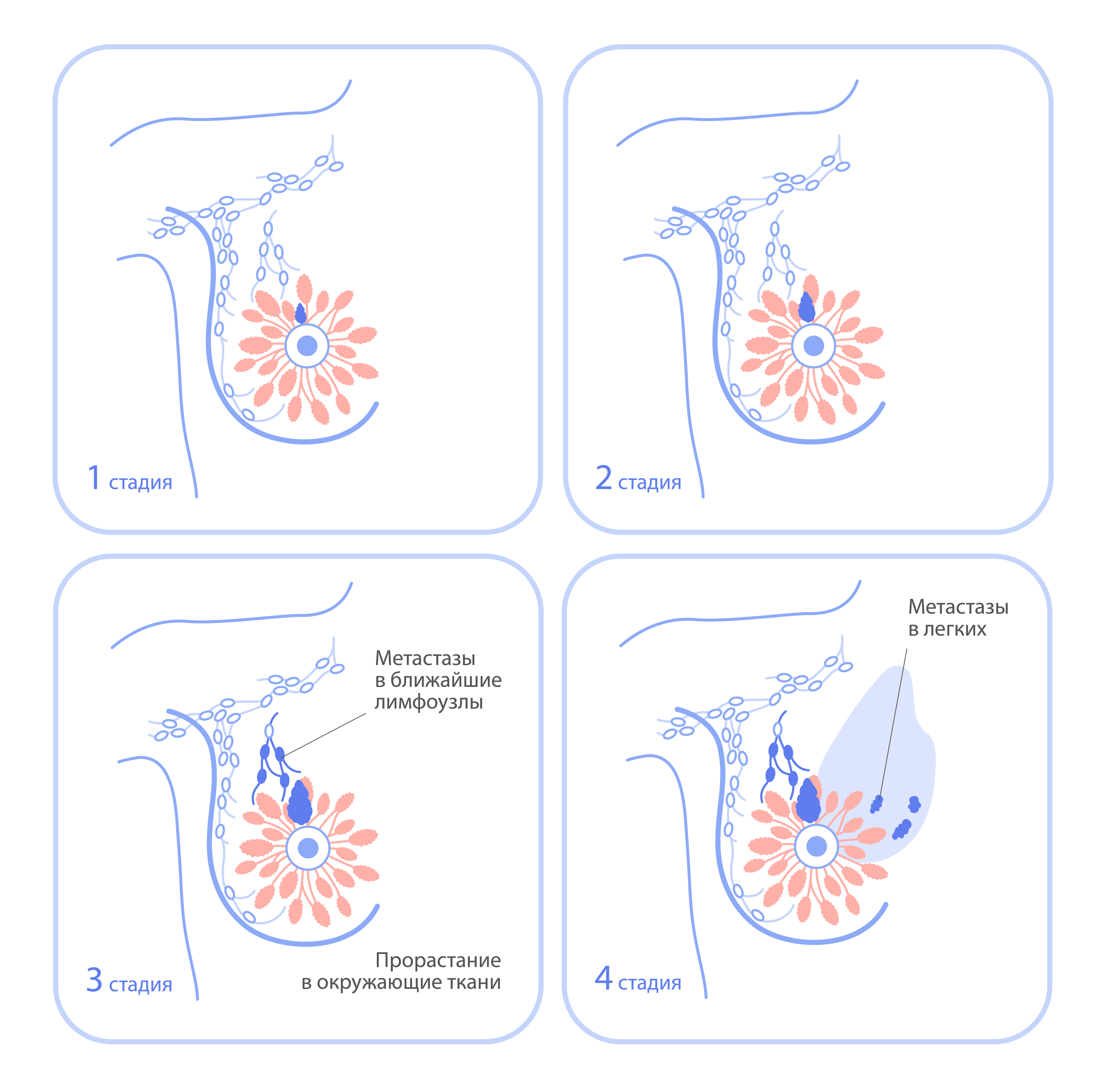 Стадирование онкологических заболеваний РМЖ.jpeg
