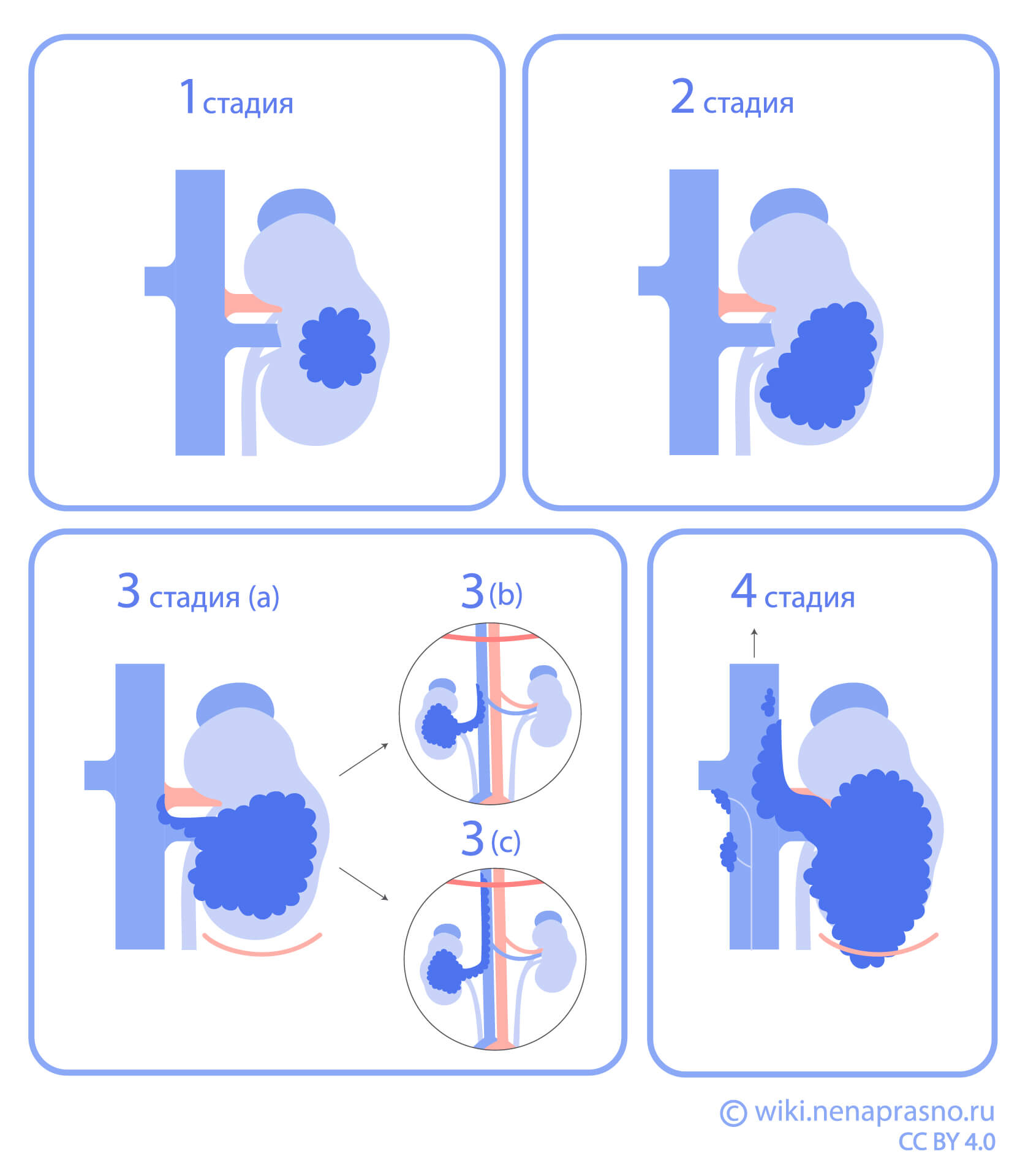 Стадии рака почки.jpg