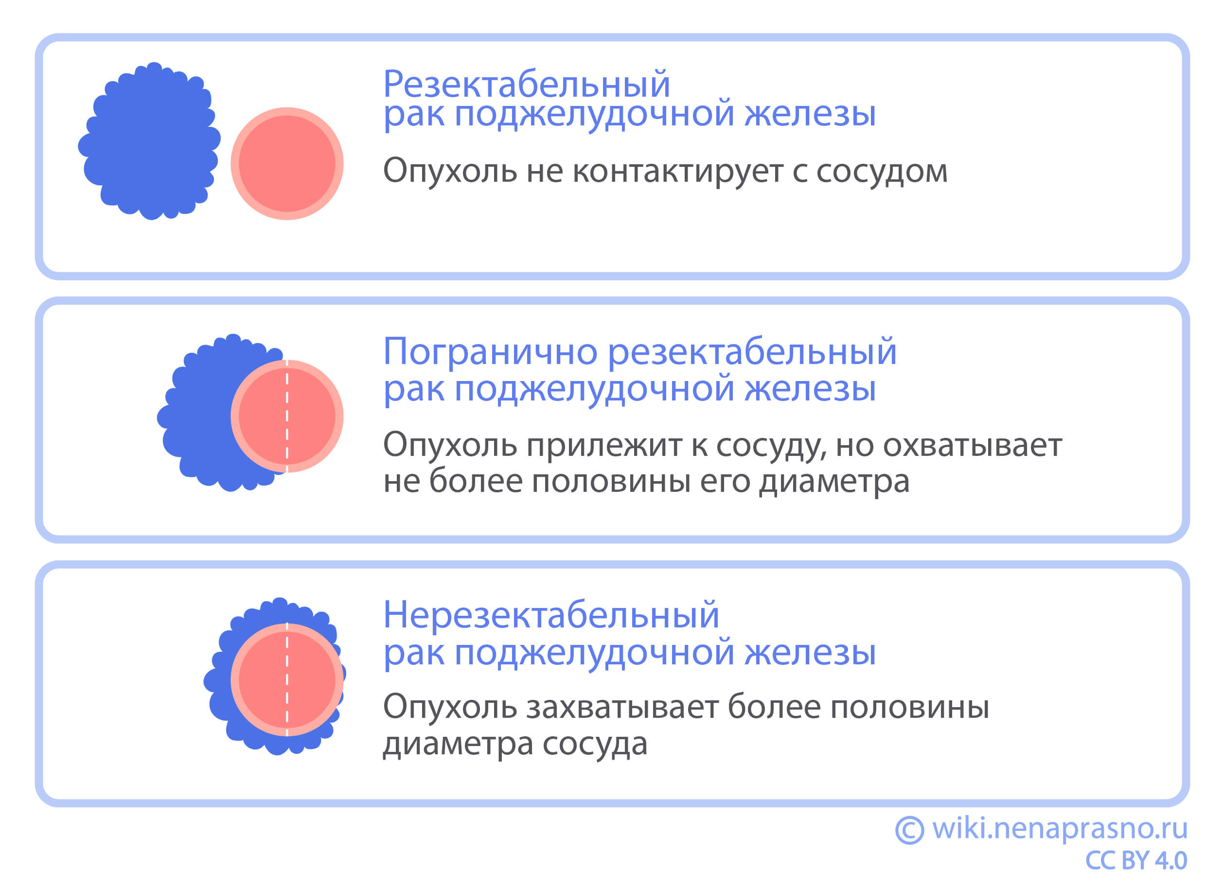 Лечение погранично резектабельного рака поджелудочной железы