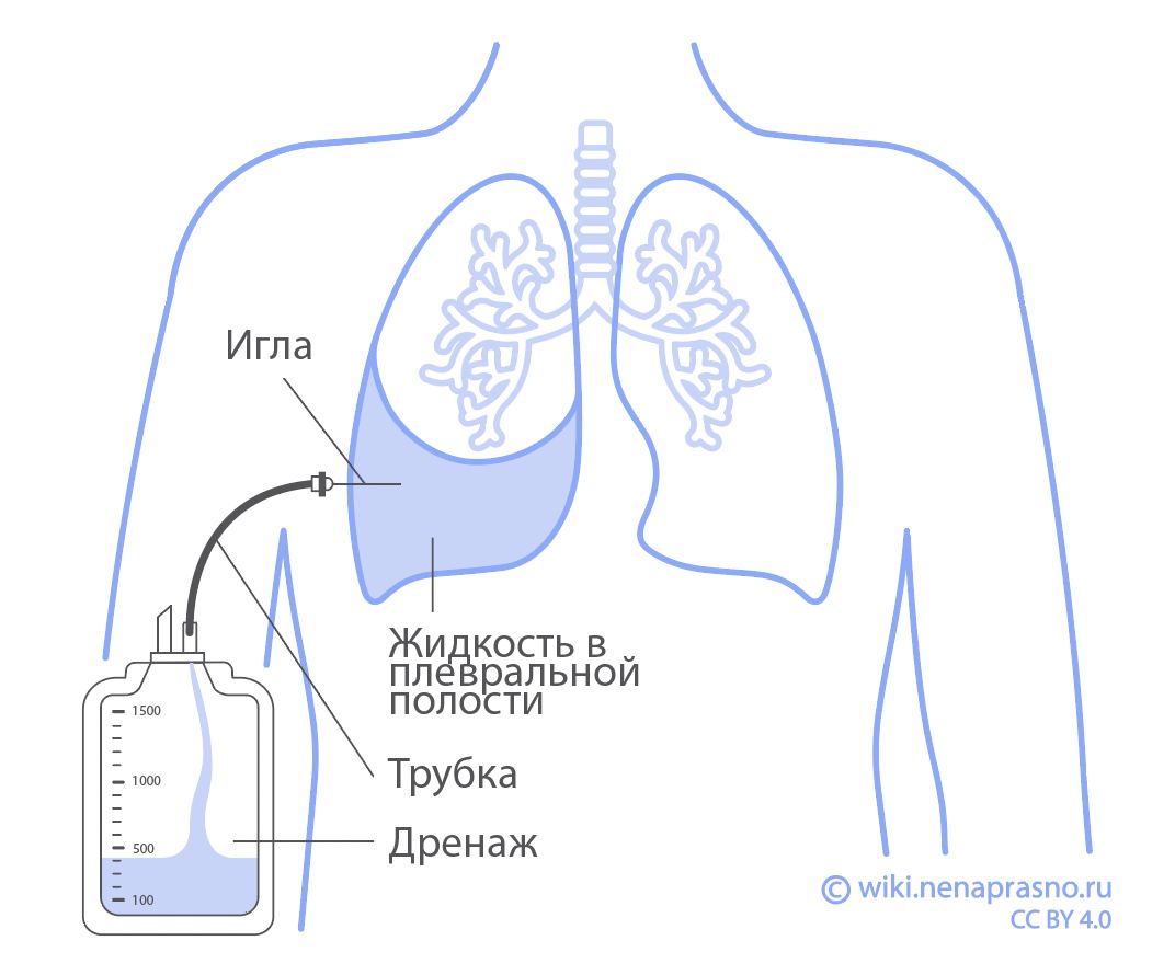 Осложнения после операций при раке печени