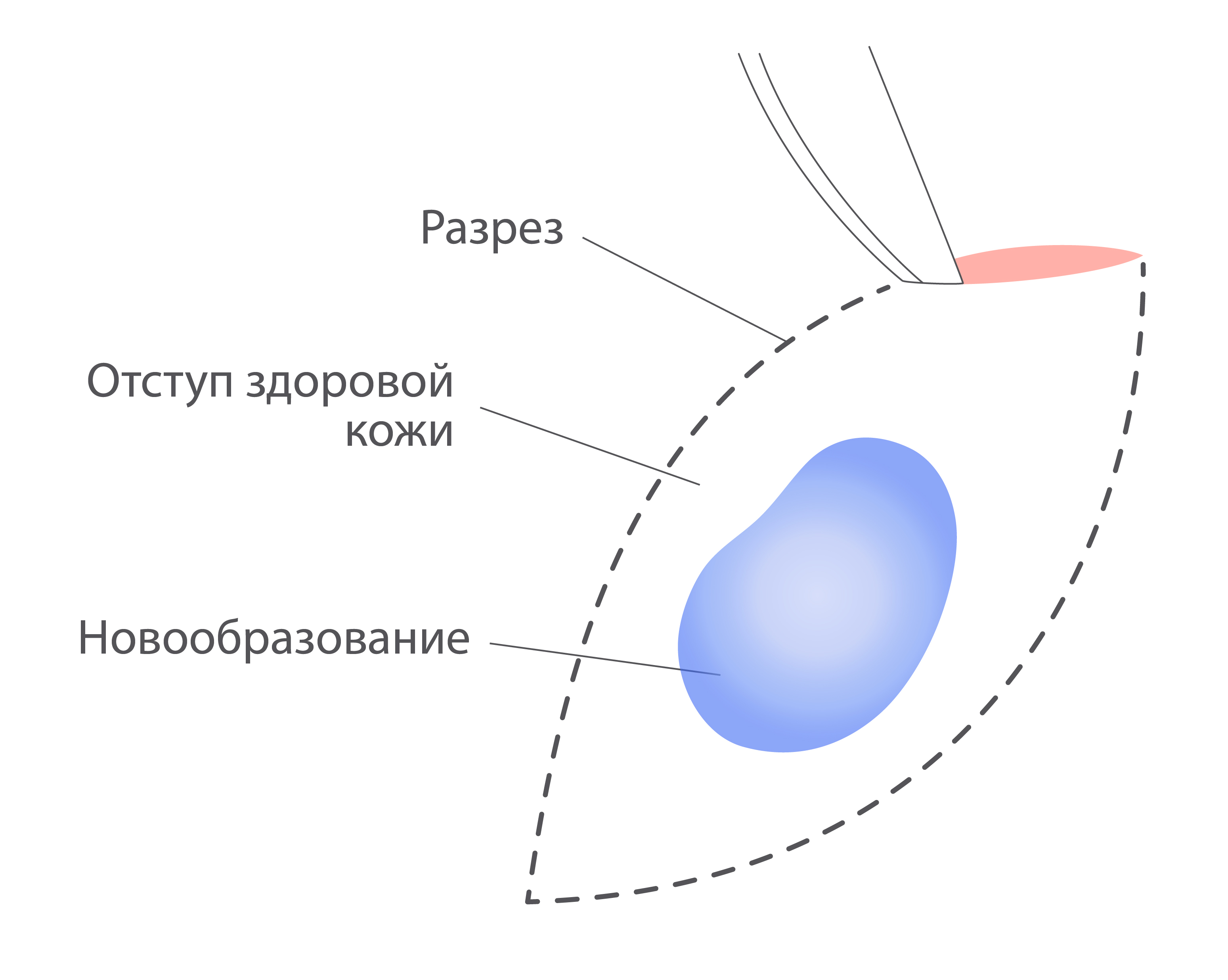 Когда необходима и как проводится биопсия?