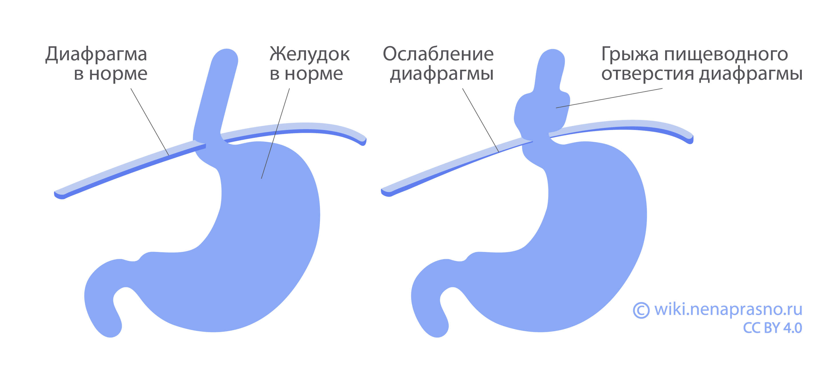 Гастроэзофагеальная рефлюксная болезнь