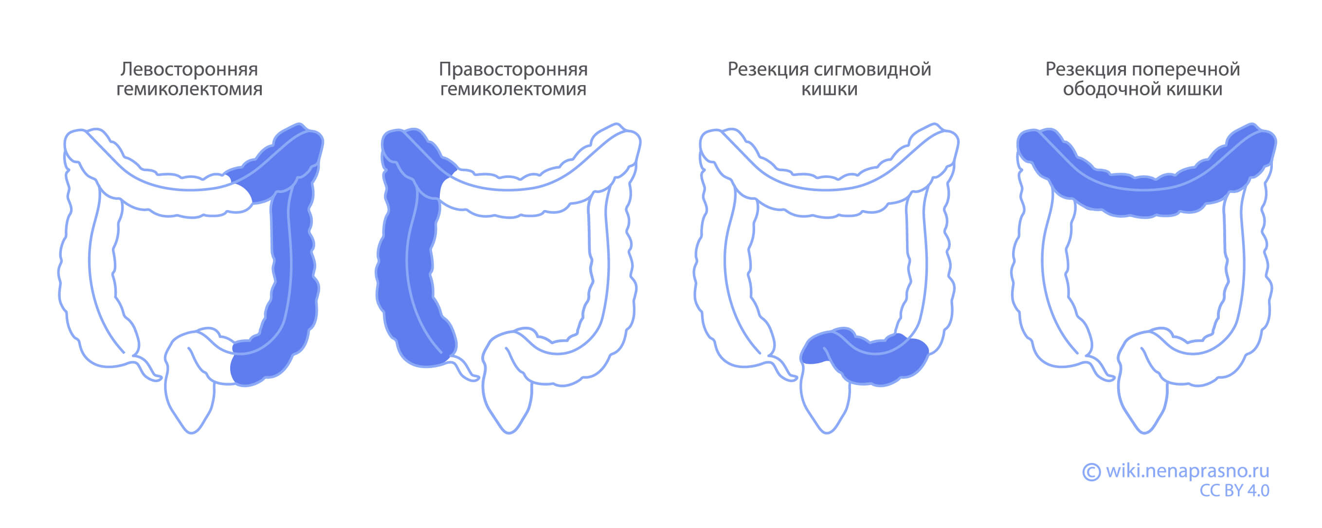 Методы хирургического лечения рака толстой кишки