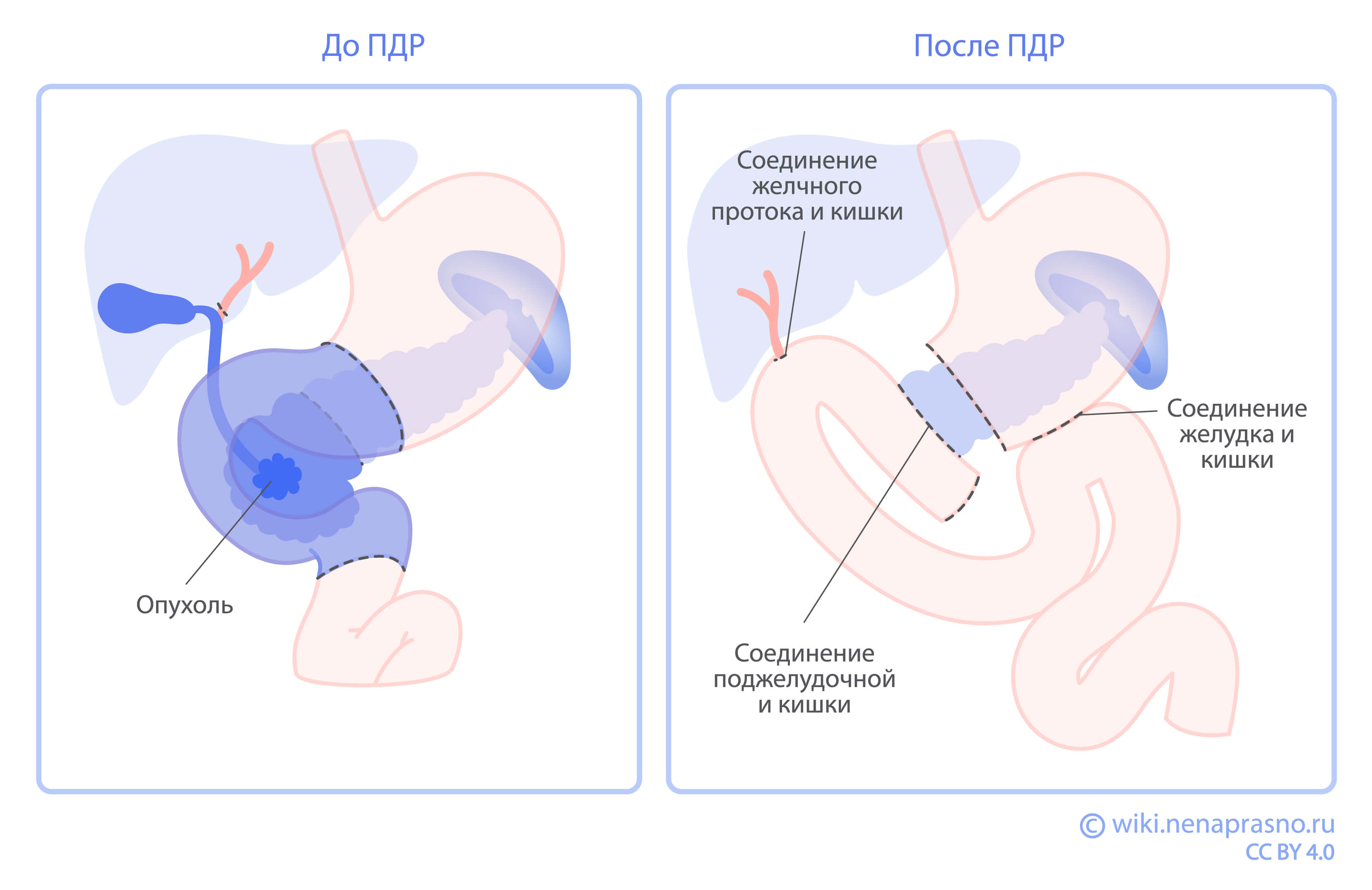 Панкреатодуоденальная резекция