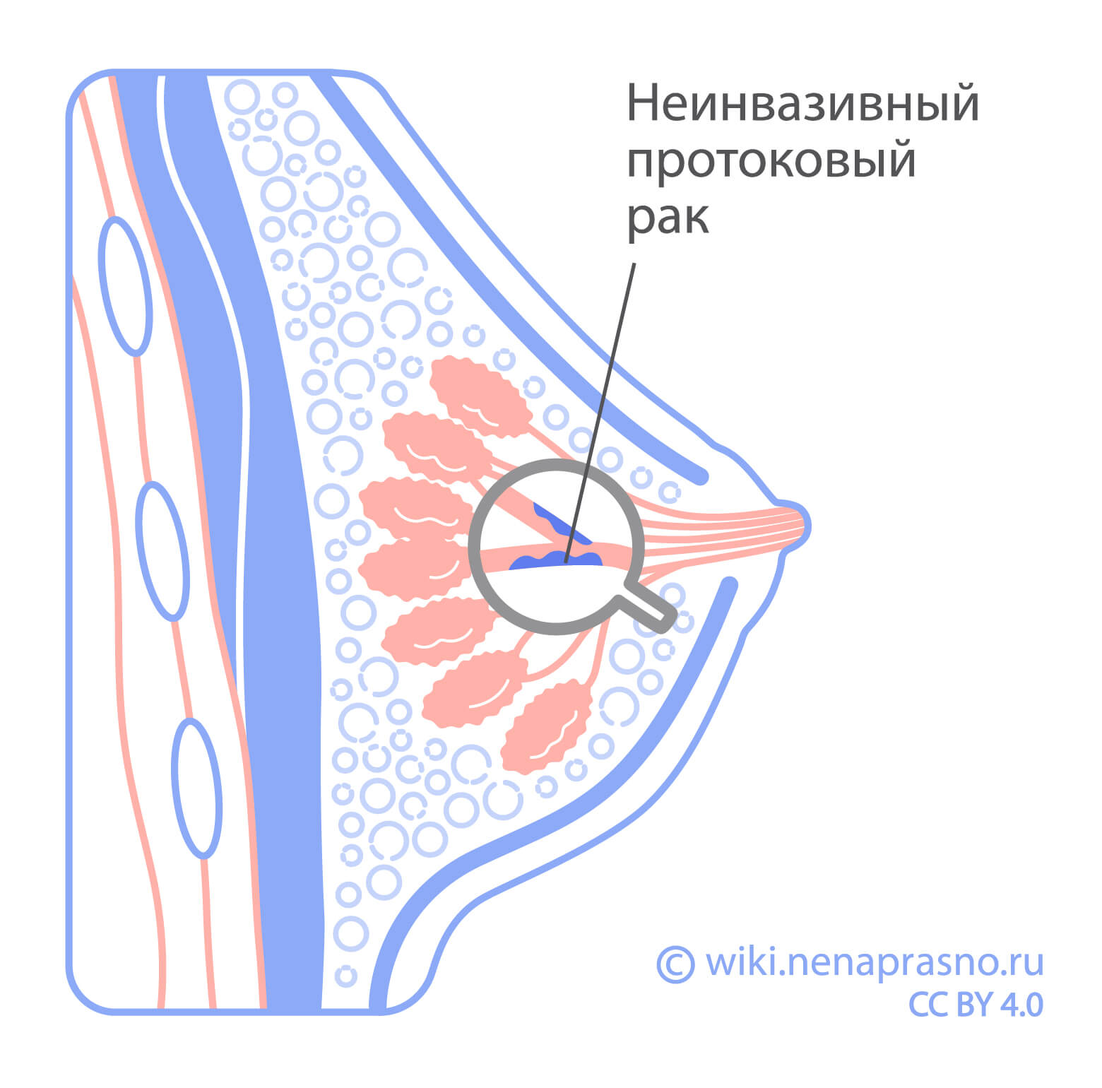 Что такое неинвазивный рак молочной железы?