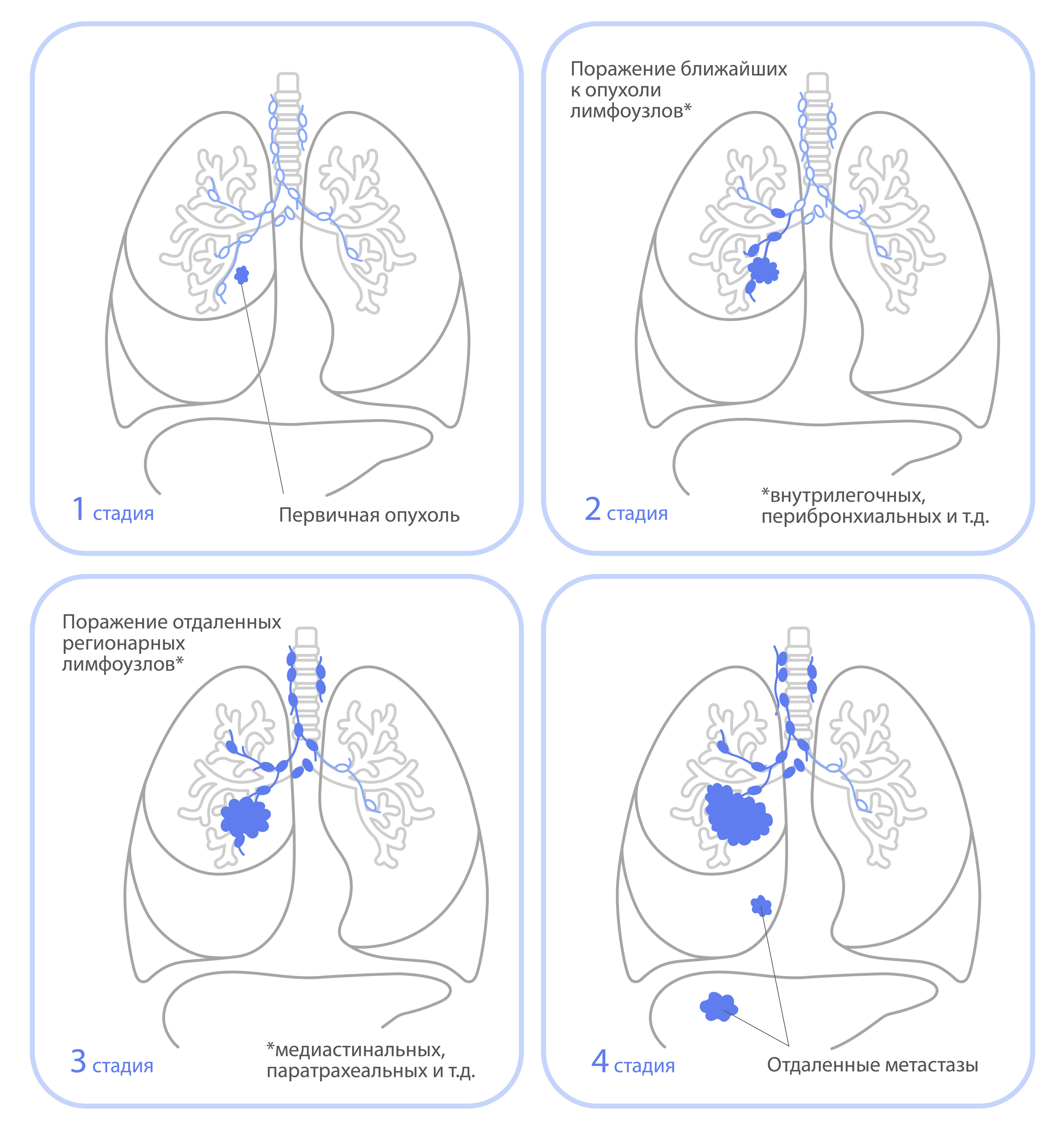 Стадирование онкологических заболеваний.jpeg