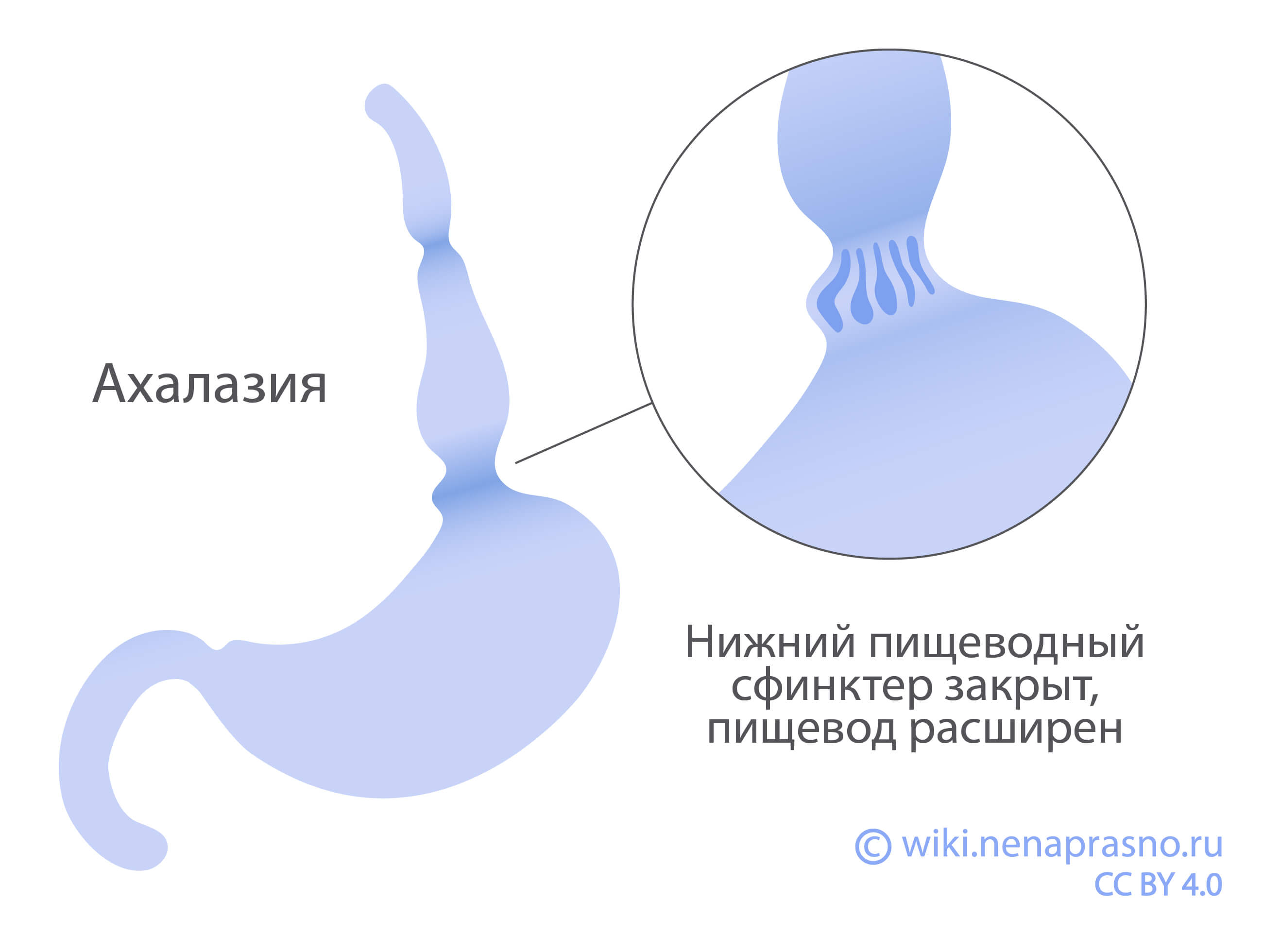 Какие болезни возникают в пищеводе?