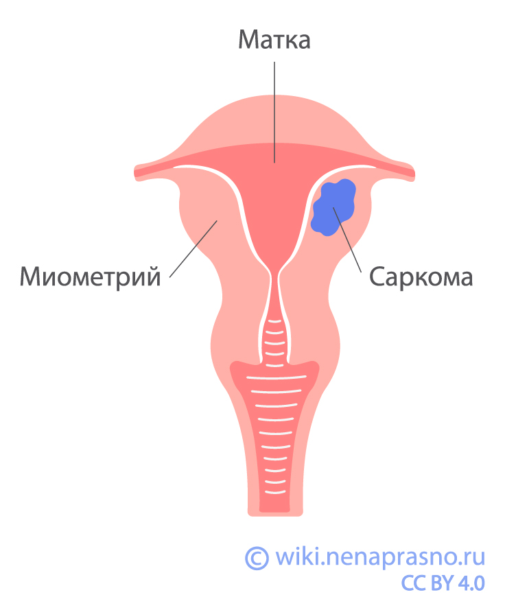 Саркомы матки