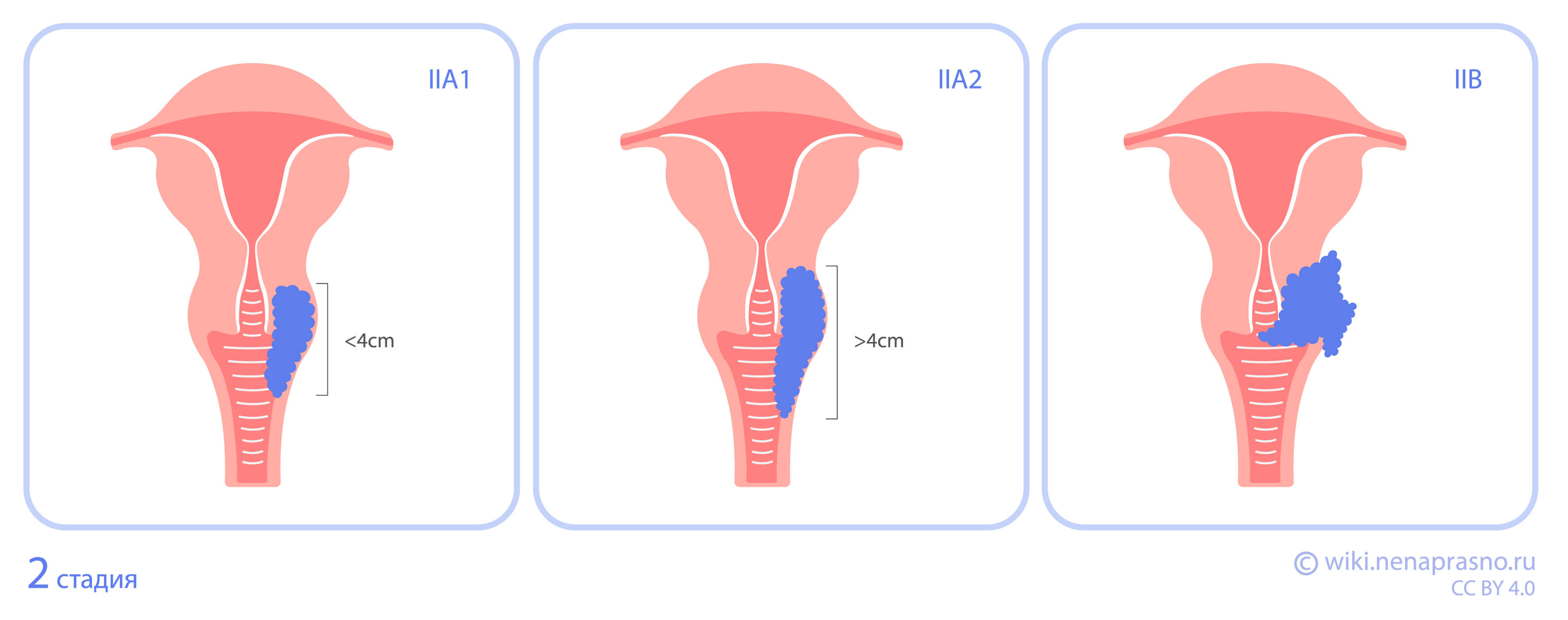 Стадии рака шейки матки