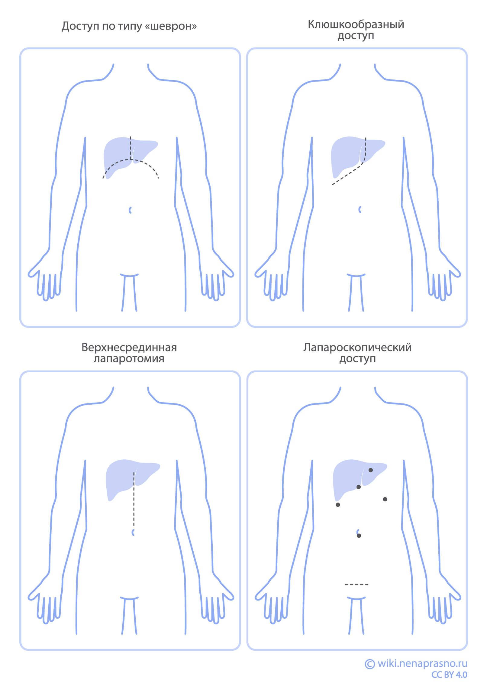 Методы хирургического лечения рака печени