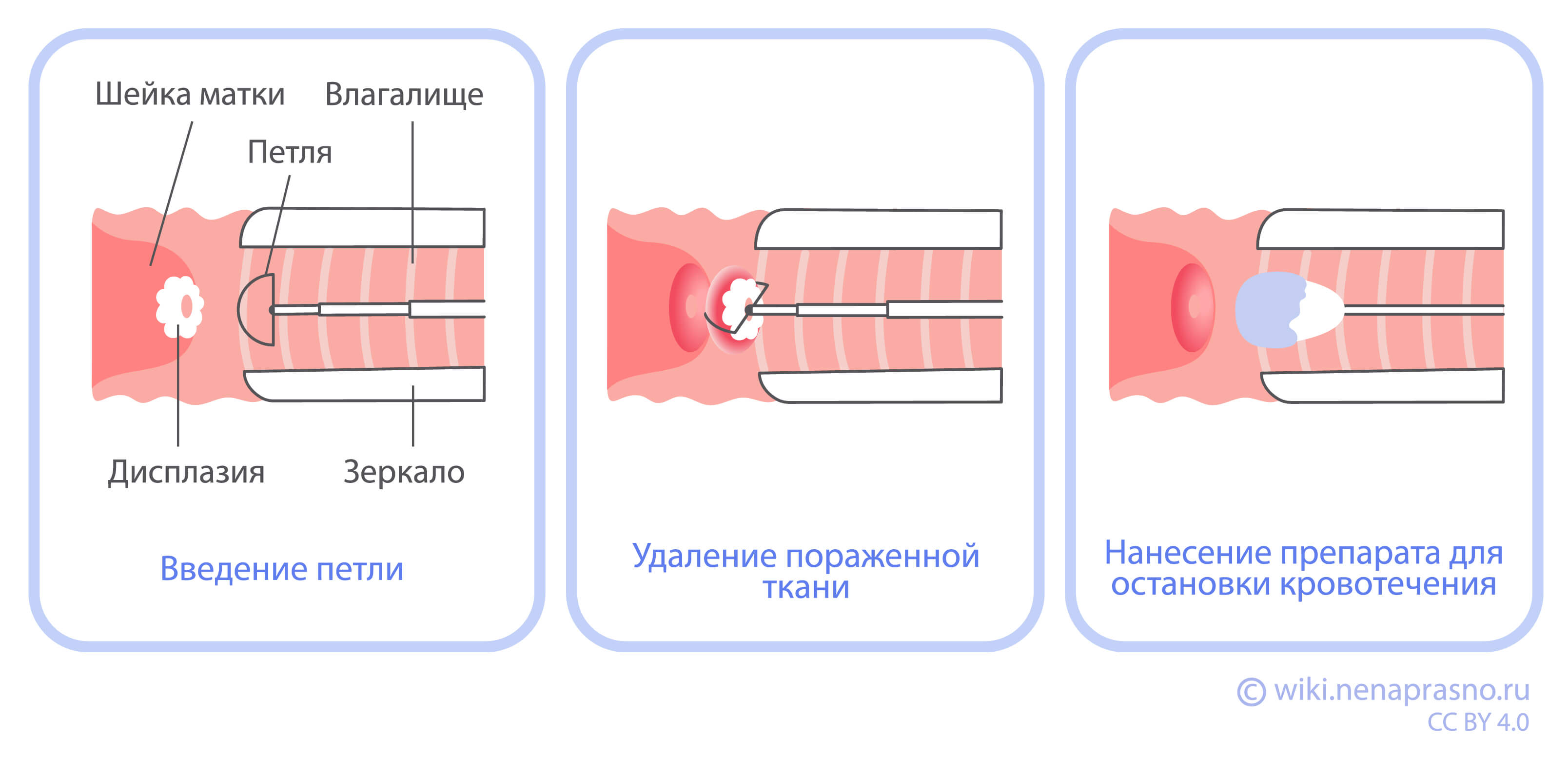 Лечение предраковых заболеваний шейки матки