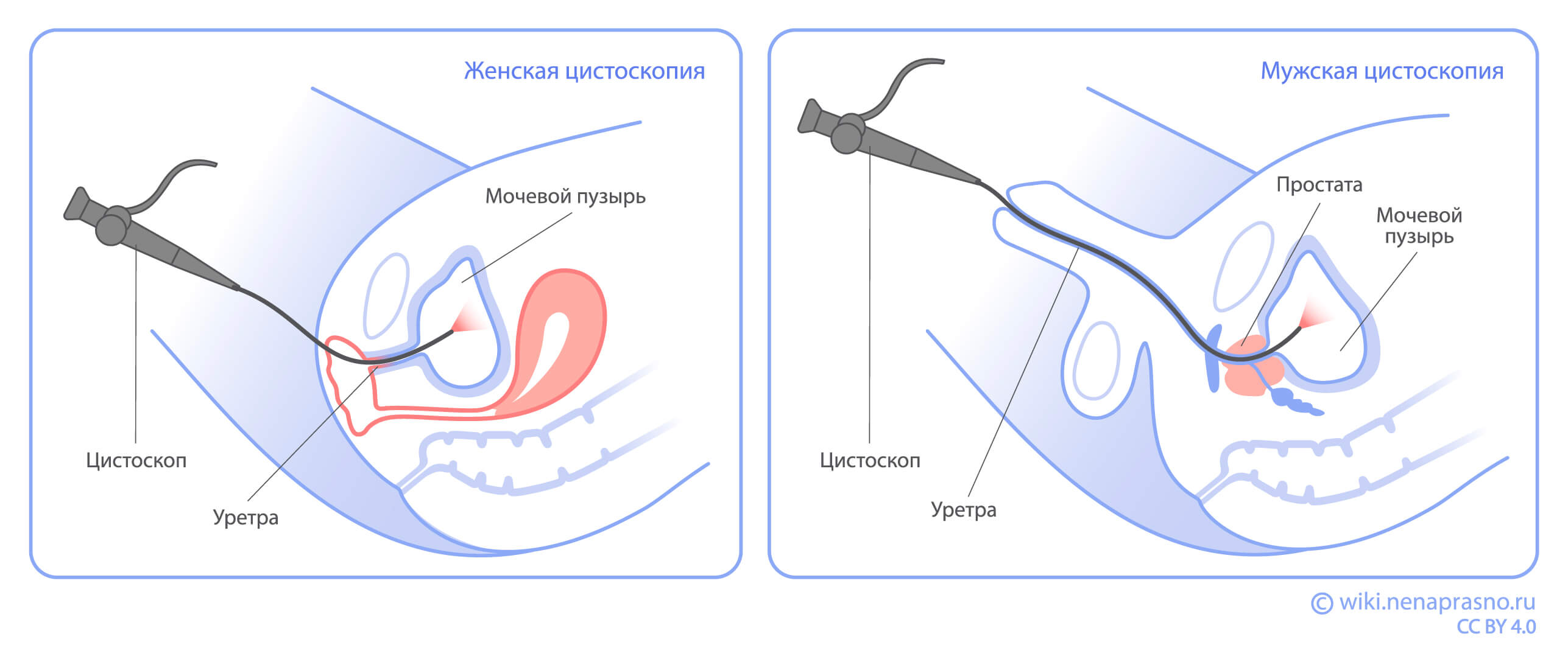 Цистоскопия.jpg