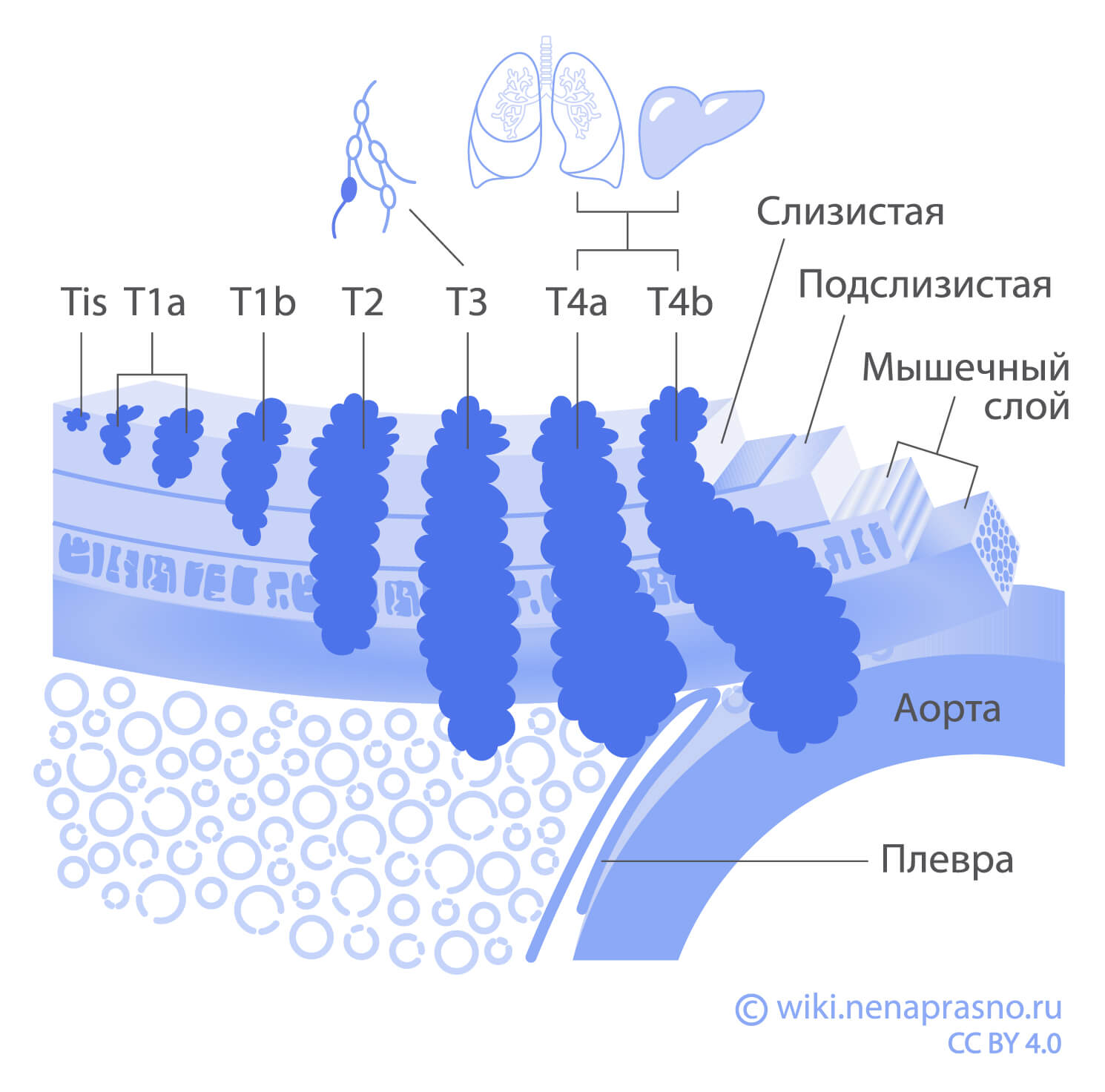 Стадии рака пищевода