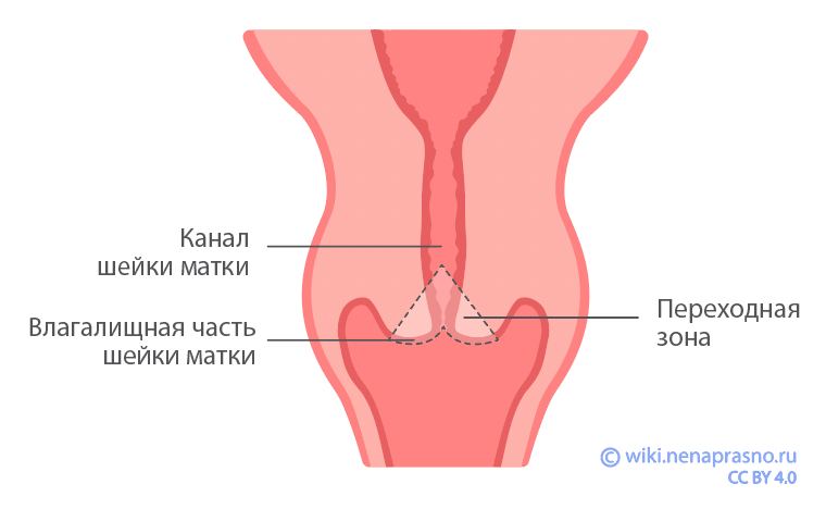 Лечение предраковых заболеваний шейки матки