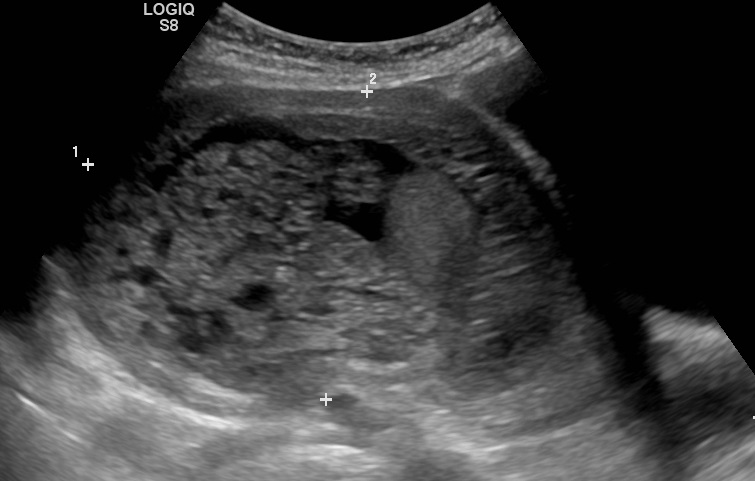 File:Molar pregnancy 0001.jpg