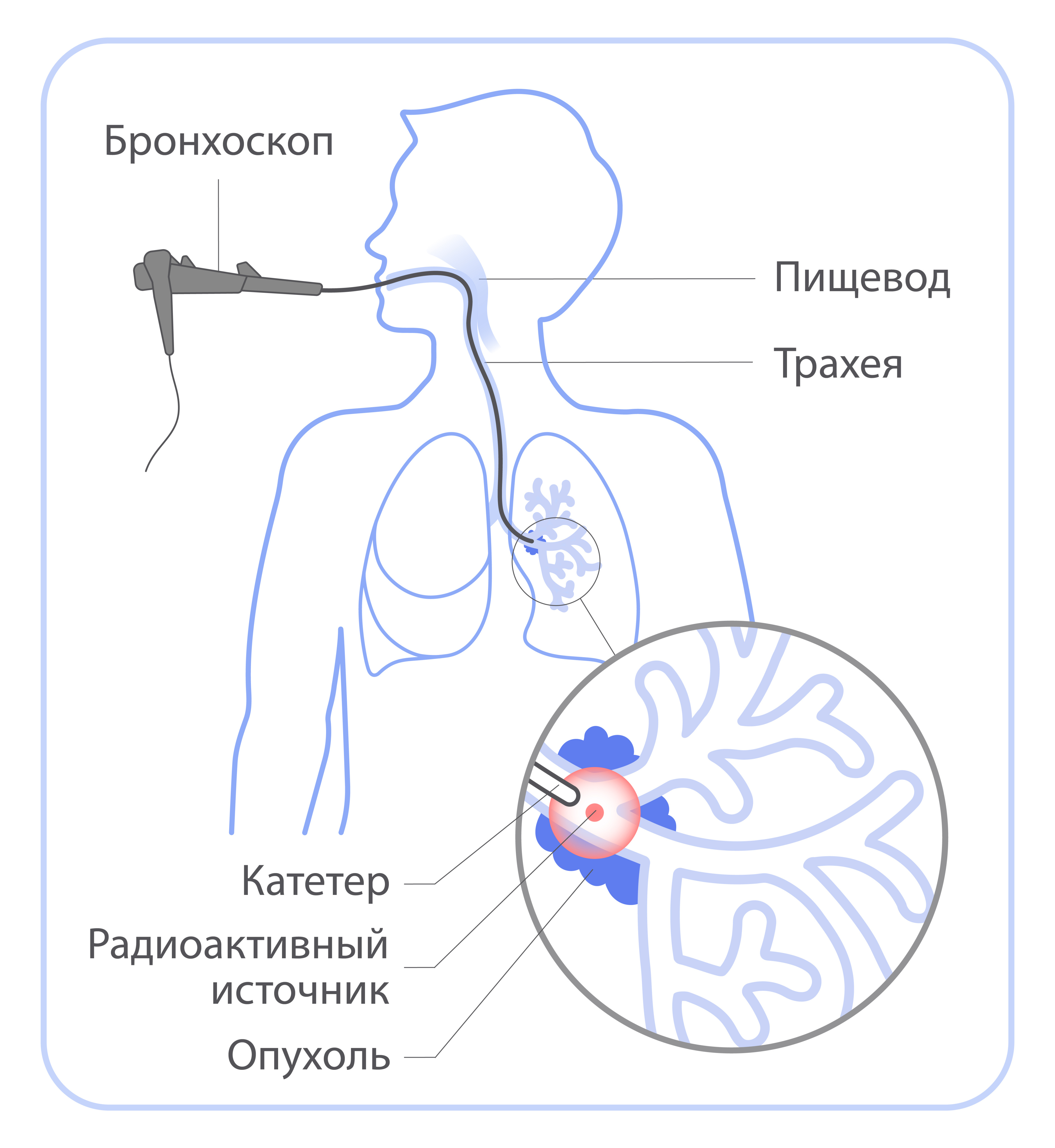 Лучевая терапия