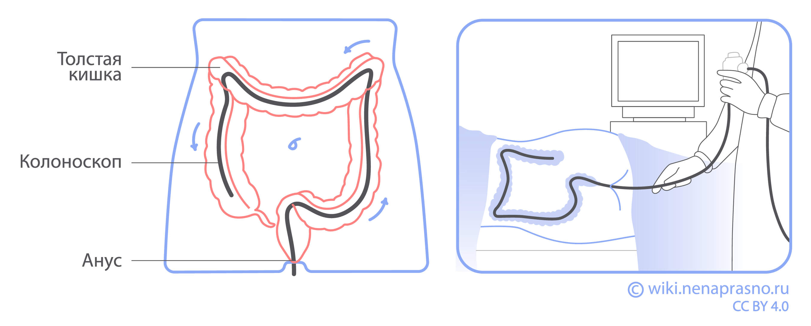 Эндоскопические методы диагностики рака толстой кишки