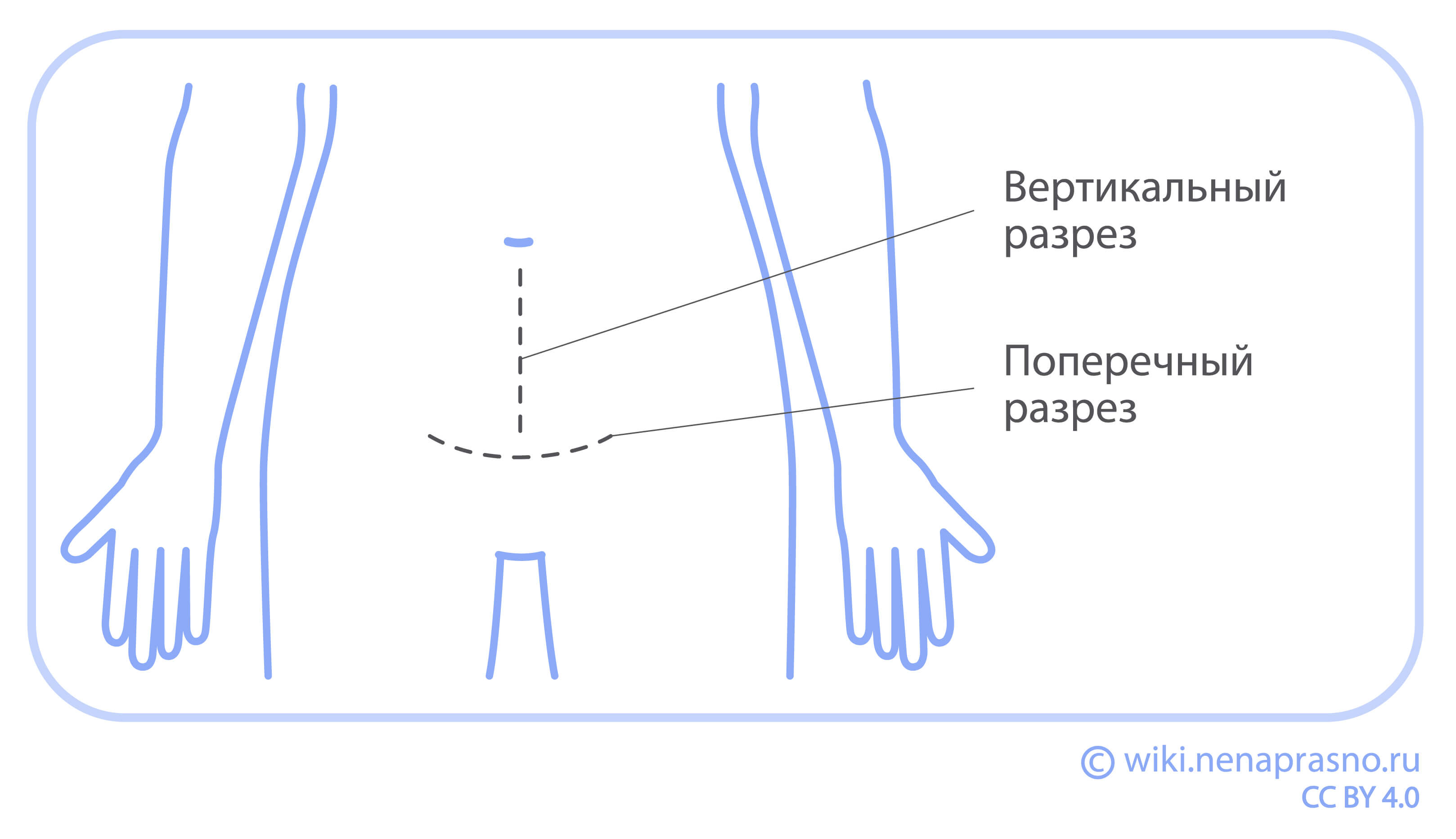 Виды хирургического лечения рака эндометрия