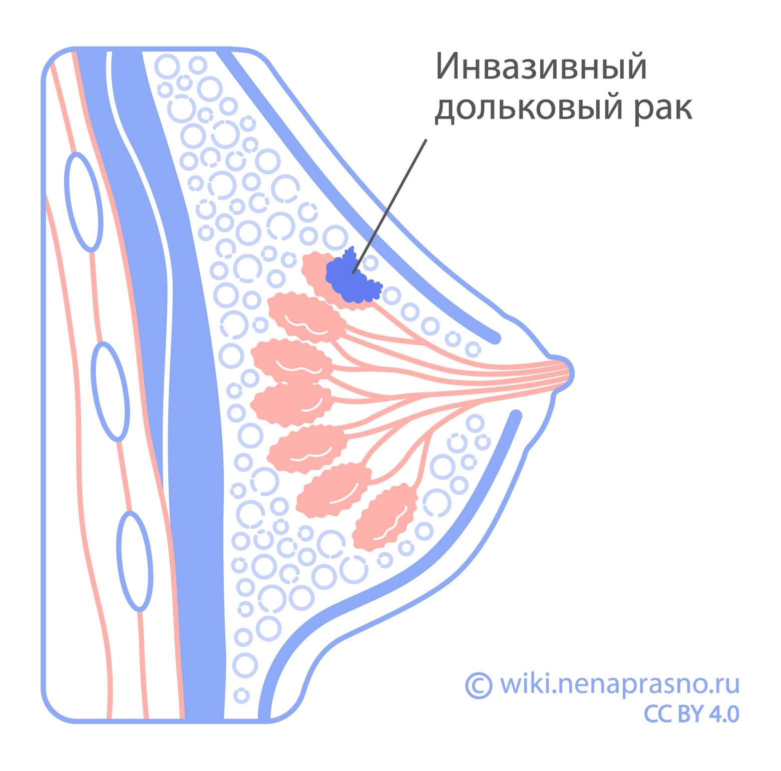 Дольковый рак молочной железы