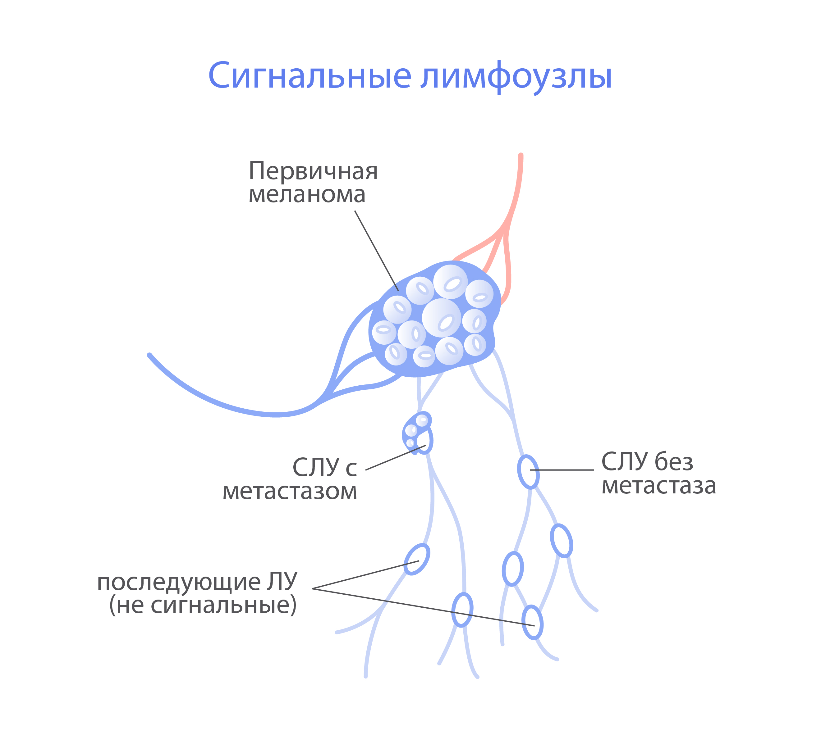 Биопсия сторожевого (сигнального) лимфоузла