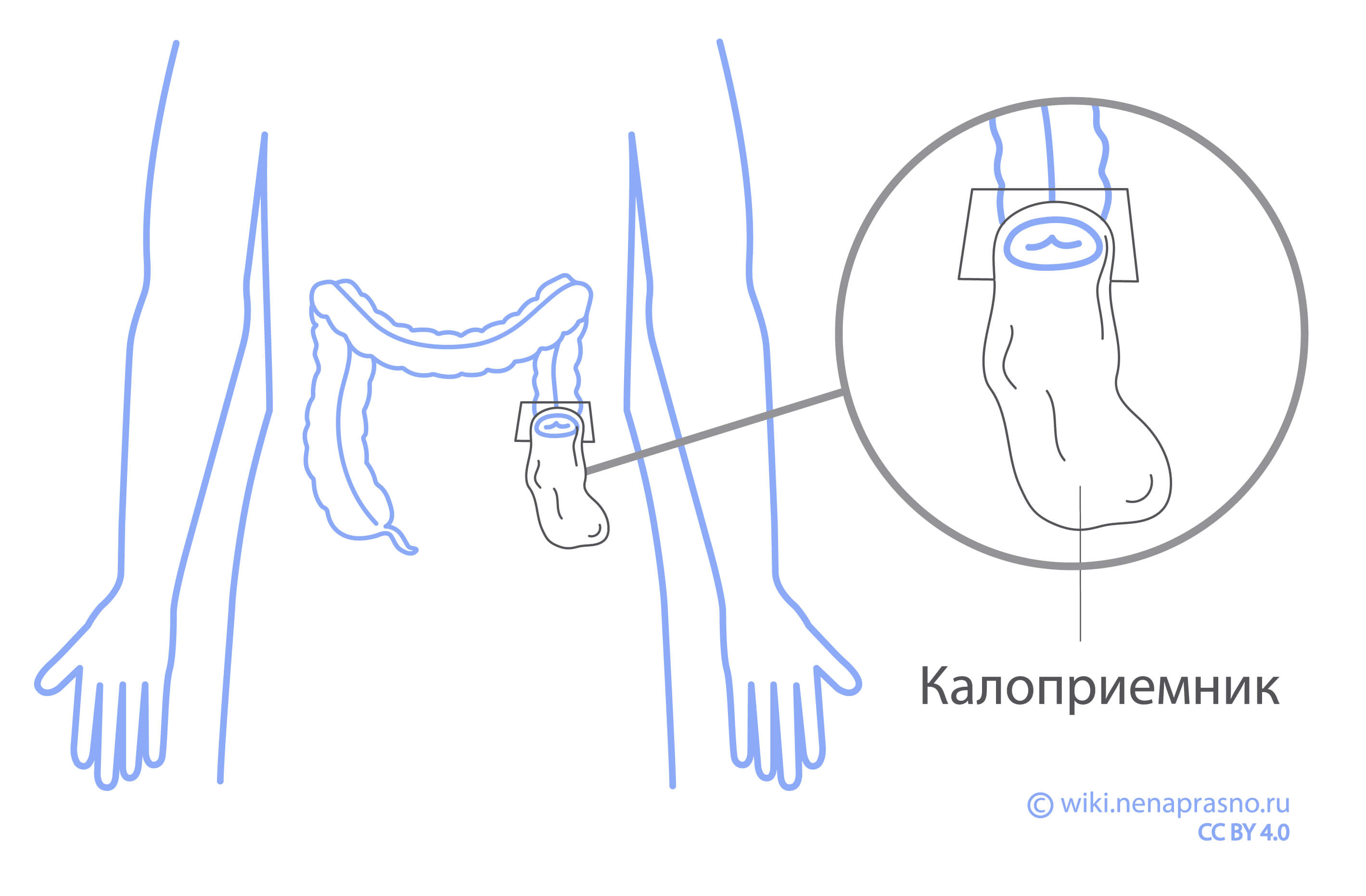 Что такое стома? Кому она показана?