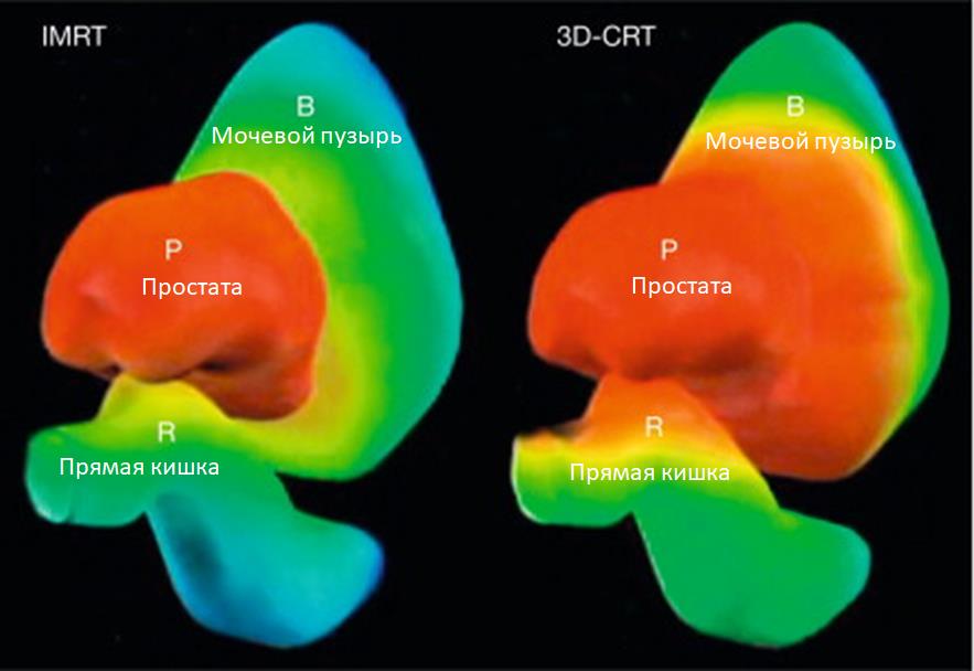 Иллюстрация точности облучения методов IMRT и 3D-CRT