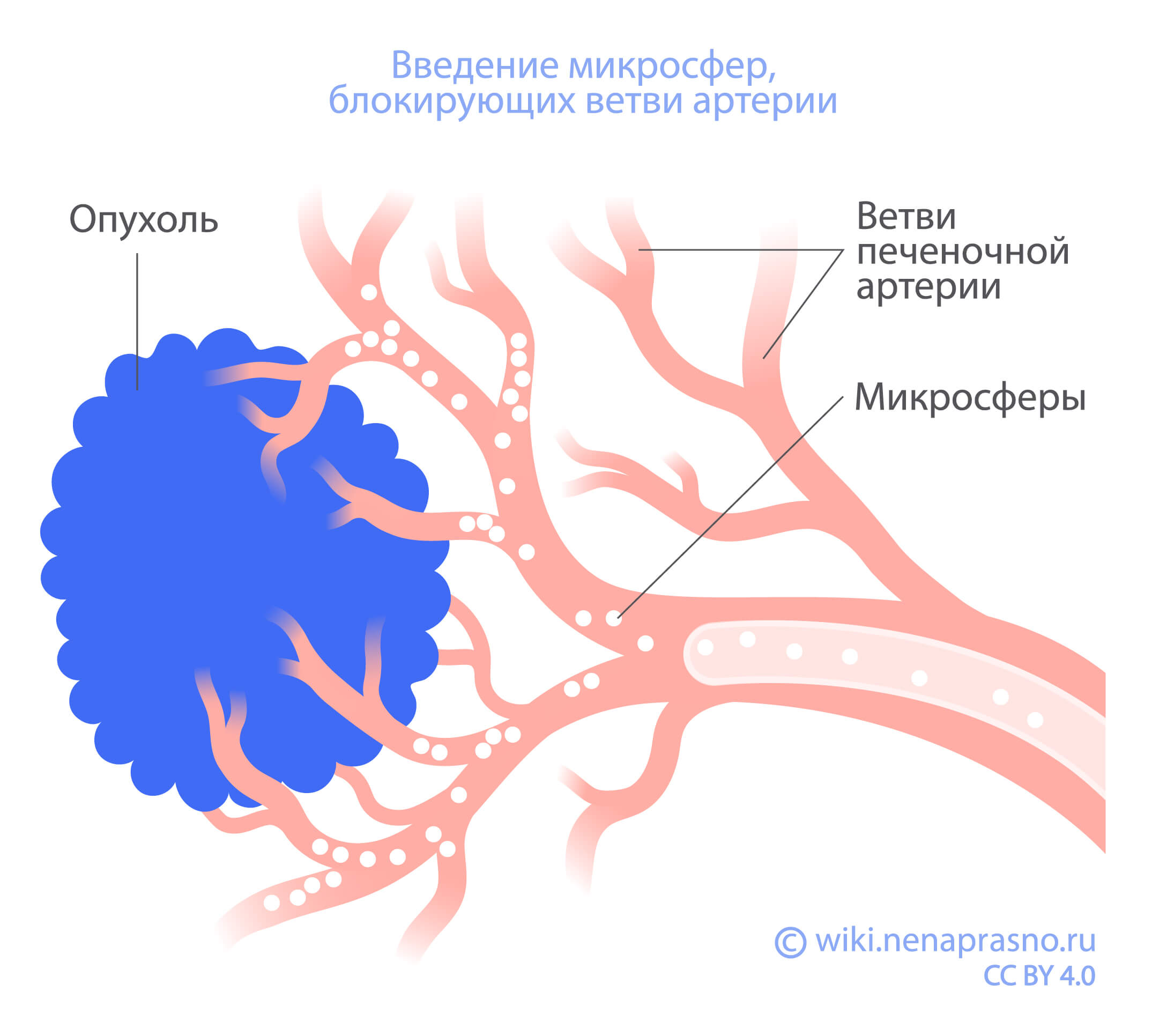 Химиоэмболизация при раке печени