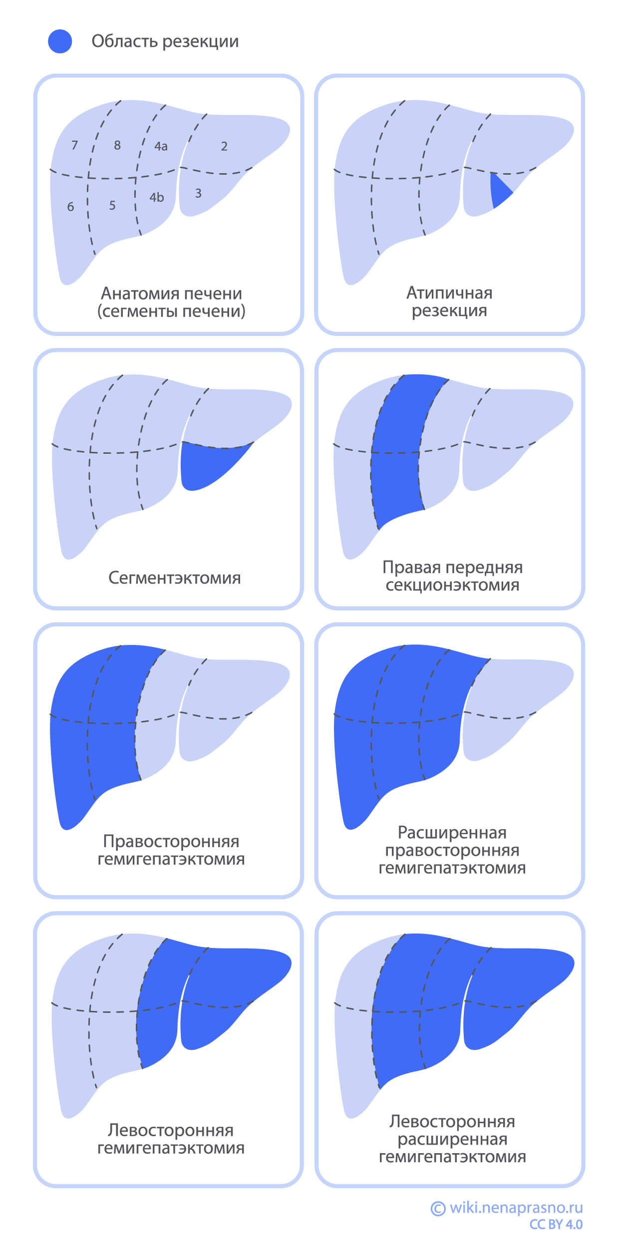 Методы хирургического лечения рака печени