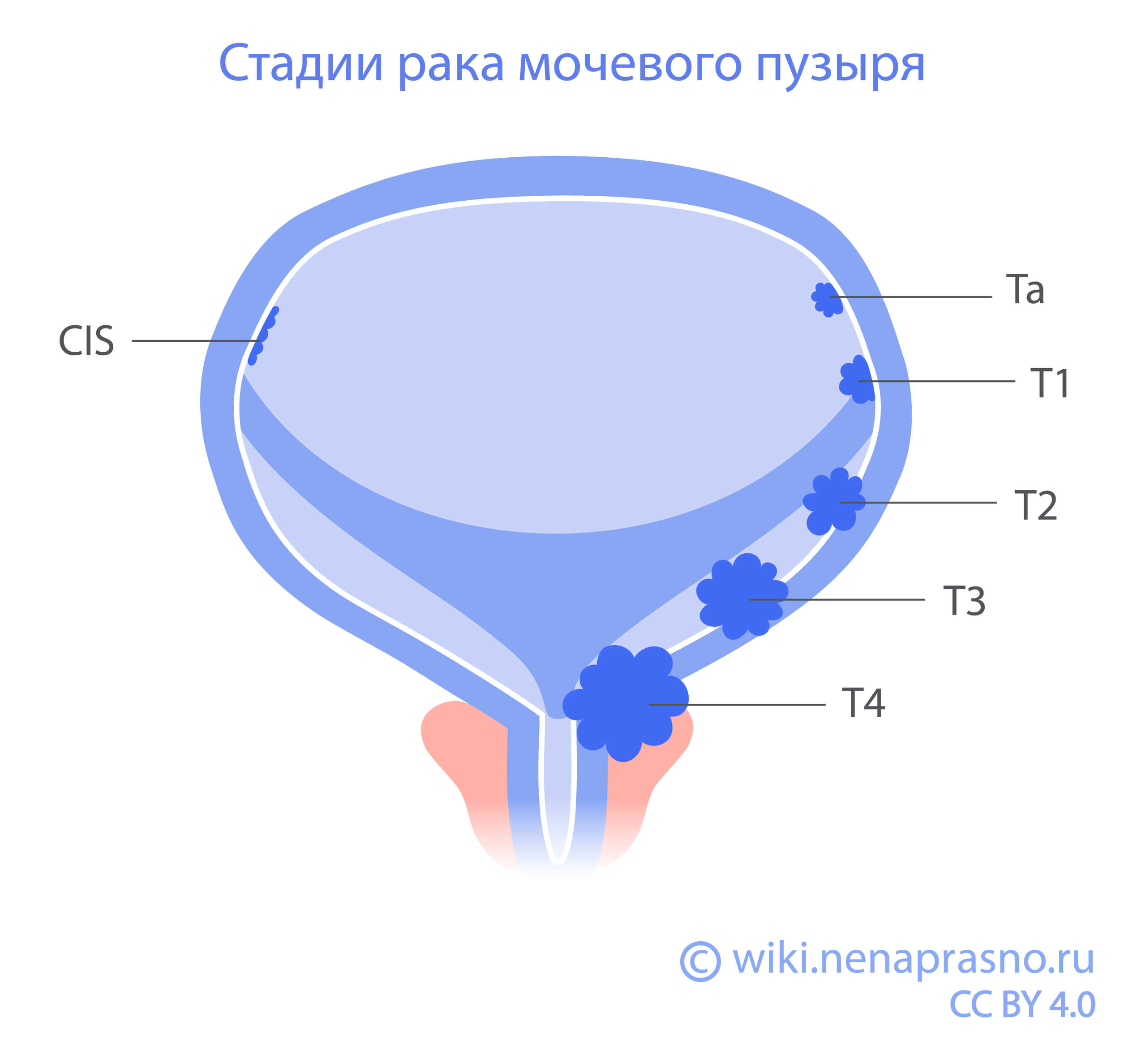 Стадии_мочевой_пузырь.jpg