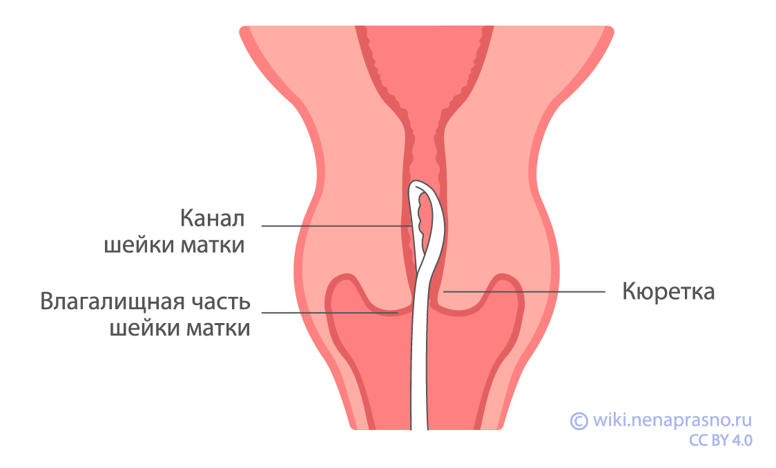 Методы диагностики рака шейки матки