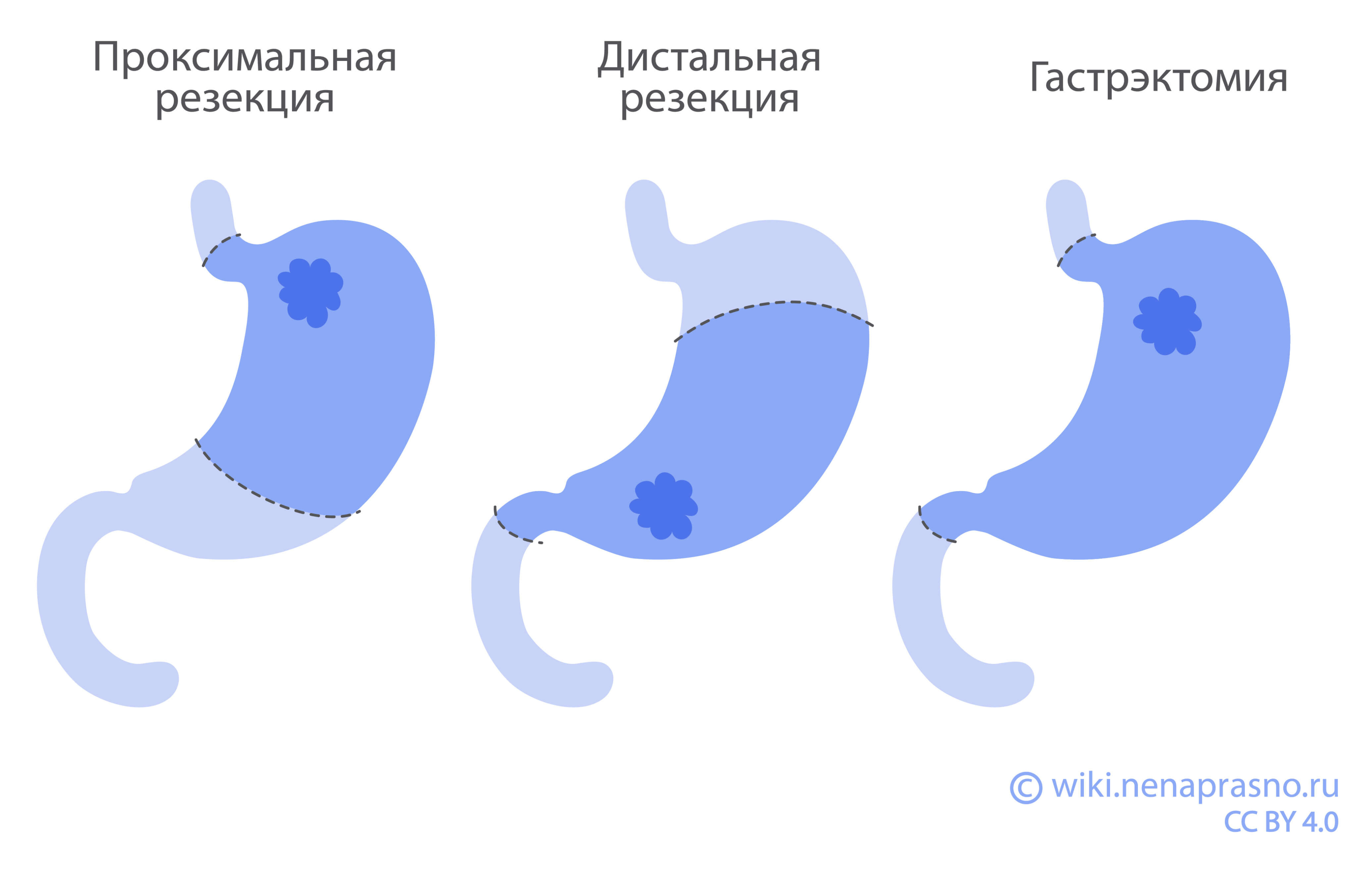 Методы хирургического лечения рака желудка