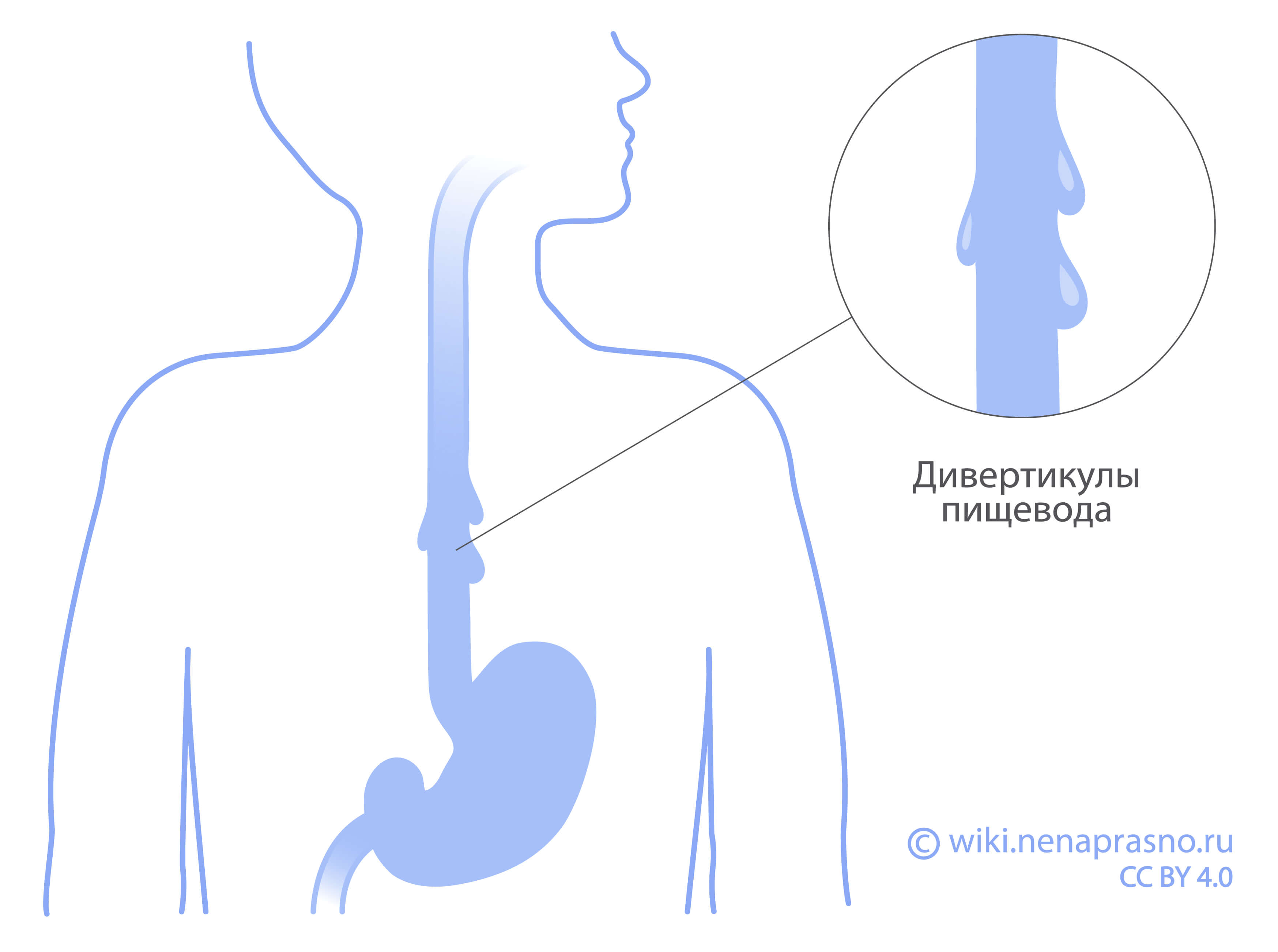 Какие болезни возникают в пищеводе?