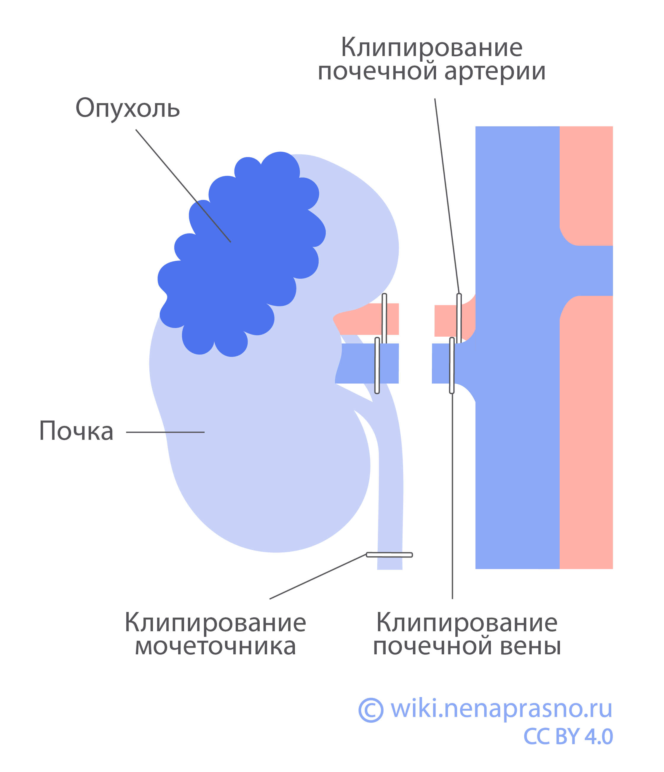 Хирургическое лечение опухоли Вильмса