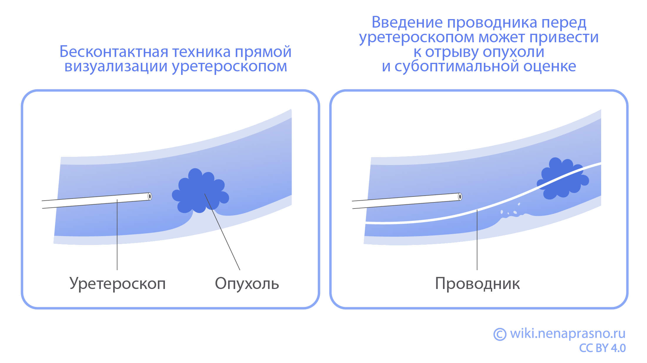 Визуализация уретероскопом.jpg