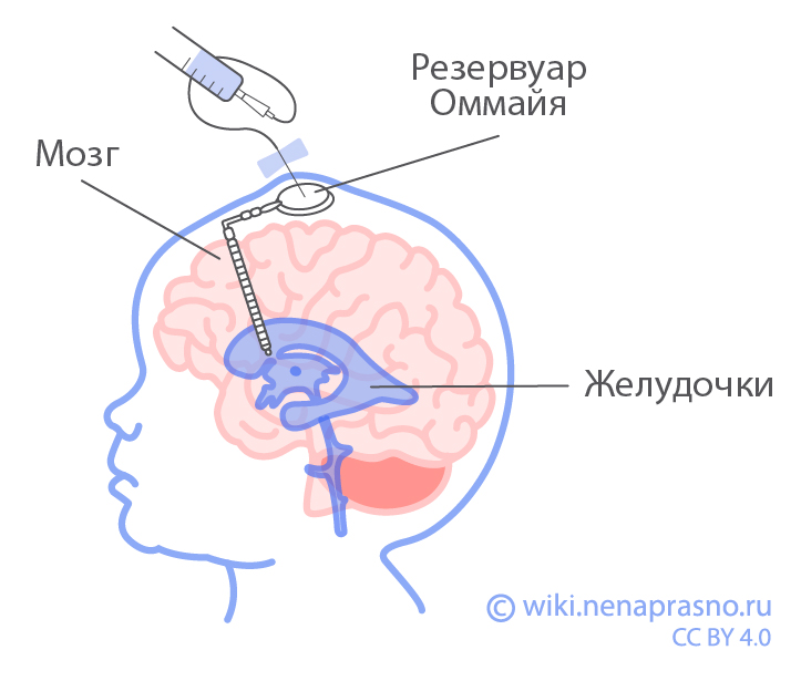 Хирургическое лечение опухолей ЦНС