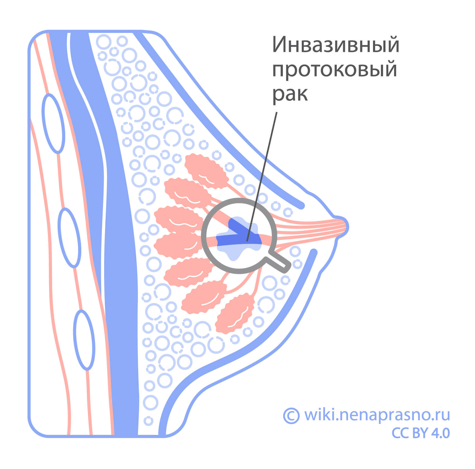 Рак груди 3 стадия, прогноз рака молочной железы 3 степени | дм-маркет.рф