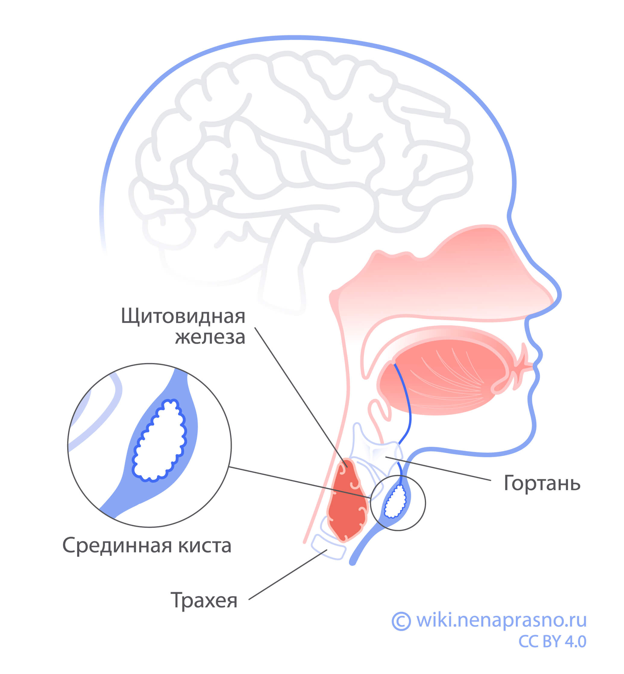 Срединная киста.jpg