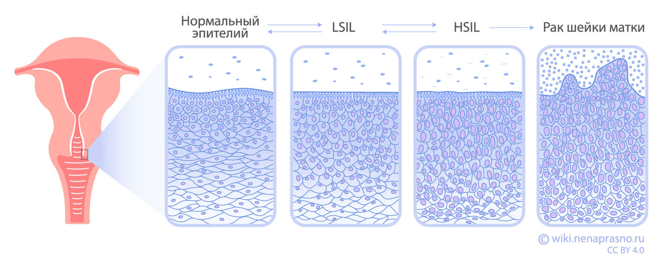 Предраковые заболевания шейки матки