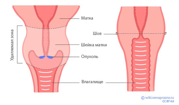 Рак влагалища: факты, симптомы и методы лечения