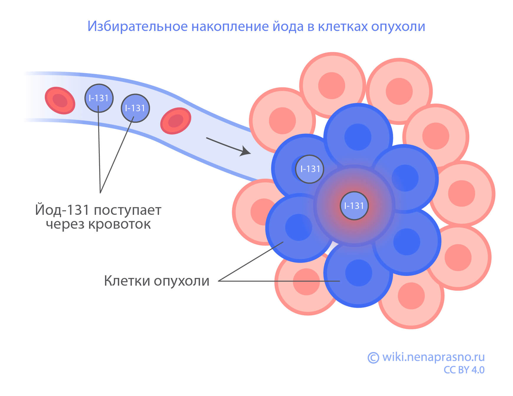 Лечение радиоактивным йодом.jpg