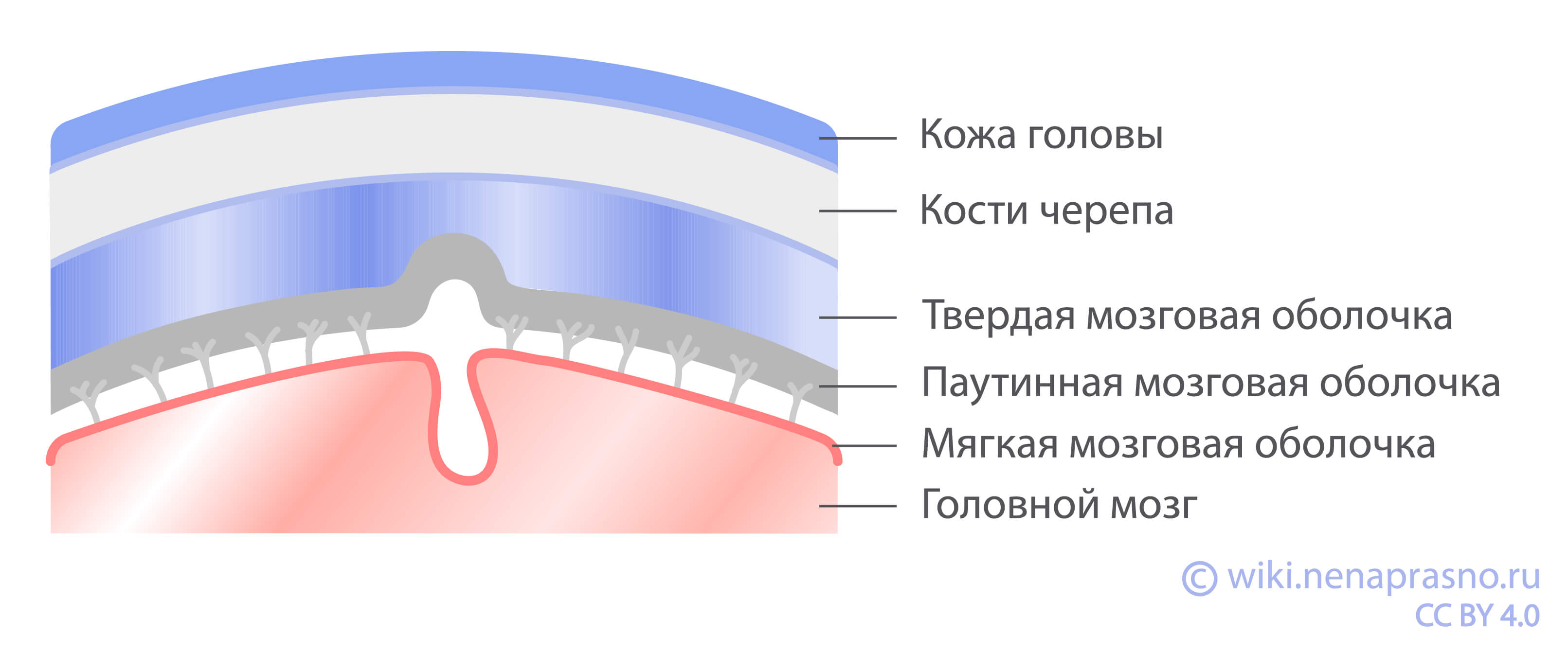 Менингиомы