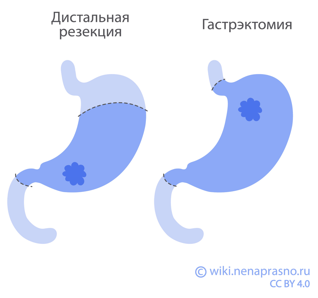 Хирургическое лечение нейроэндокринных опухолей