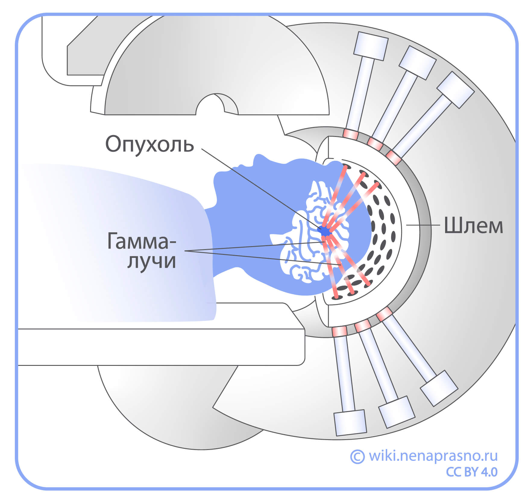 Лучевая терапия опухолей ЦНС