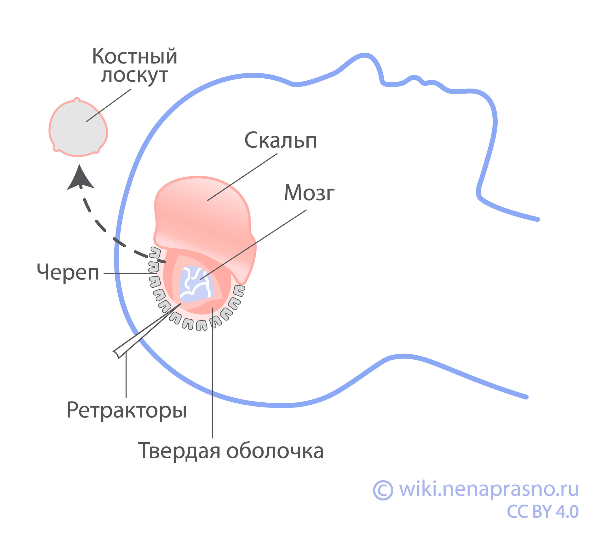 Хирургическое лечение опухолей ЦНС