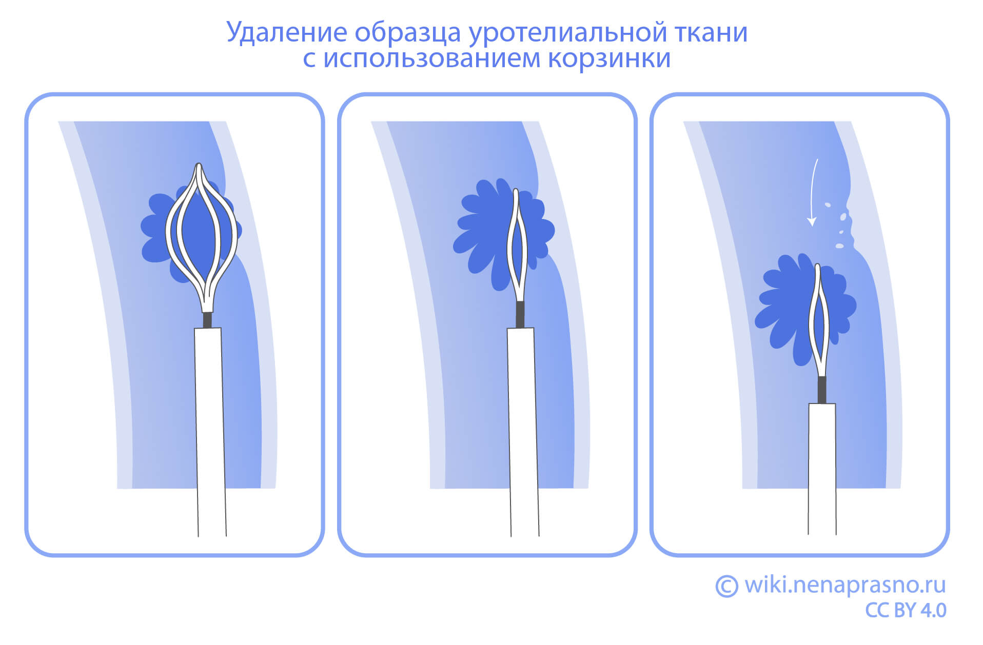 Корзинка удаление образца уротериальной ткани.jpg