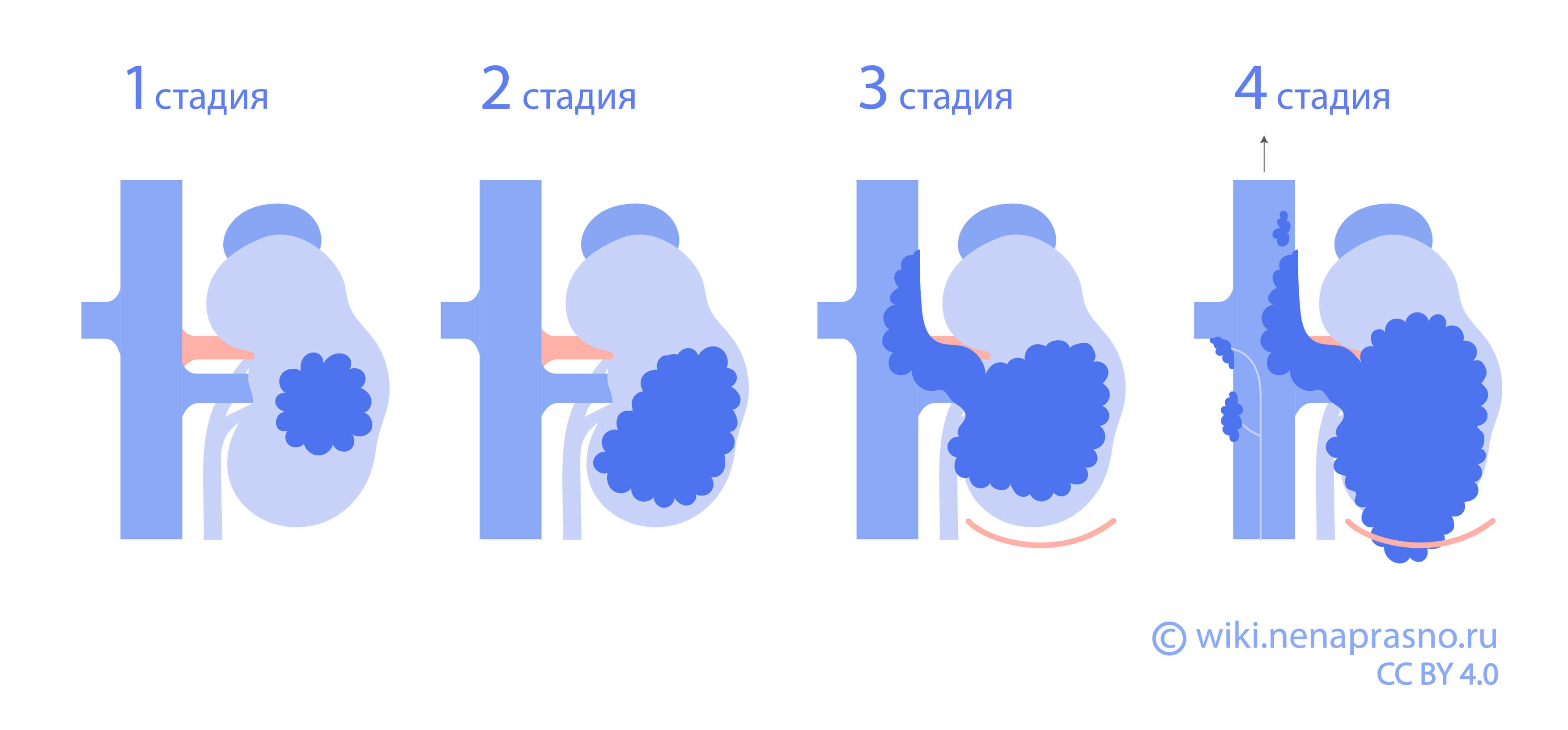 Стадии опухоли Вильмса